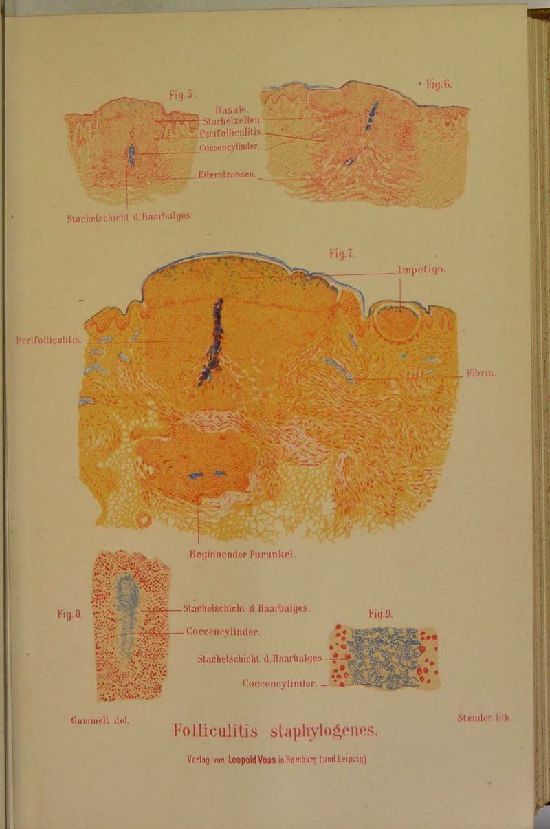 r.itei'.stpassen ' ' ’-H Staclielschichl d.Hnarbalges. Irnpetigo. Perifolliculitis. Fibrin. V.;. GuiiimeR lirl. Beginnender Furunkel. Stachelschicht d.Haarbalges. Coccencvlincler. Staclielschichl d.Haarbalges •_ Coccencylinder. -—• Folliculitis staphylogeiies. Stender lith