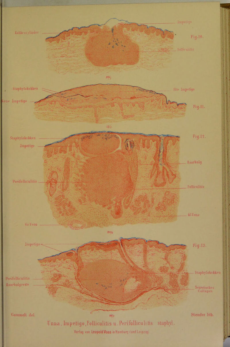 ieue Impetigo Kokk»- n r rliinler Impetigo v* F,:i . so/t .:>r* ' •. ' .T . *5: -*< fr. M ^ , v‘* ■ ••• W**' iphylokukke Impetigo fnllic ulitis ttr Venu Impetigo Perifolliculitis liaarbalgresle Fig.ll. Fig.l?. Haarbalg Folliculitis' _ kl .Vene ’ c Fig.I'.l. Staphylokokken j .j_ -. Nekrotisches Collagen flummell del. «O./ Stemler litli. Unna, Iiupetiyo.Folliculitis u.Hcrifolliculilis staphyl.