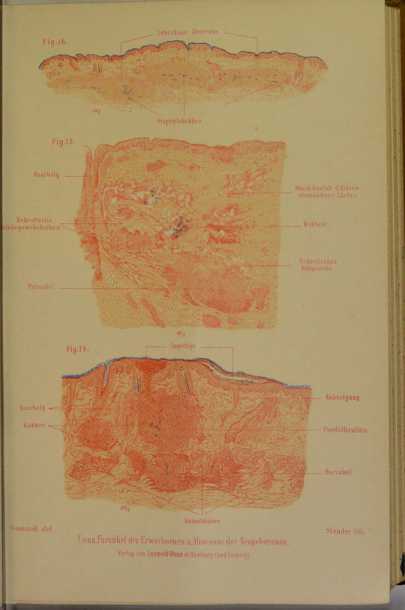 Fiij.l 5 Haavbalg Nekrotische ündeyewebsbalken Furunkel durch Aus fall d.Eiters entstandene bücken Kokken Fit), l'f _j ^X' !T \X: ••:■ -V *0.1 Impetigo I Nekrotisches Fettgewebe - Kiiauelgaug Peri Folliculitis Furunkel *•. ■ («Umwelt tlel. Kinüieldrbson Stornier lilii. | iiuaj'iii'iiiikt’l tltT Kfwttcliseiit'n\i;\l»st esst* dos* pboriMtPii