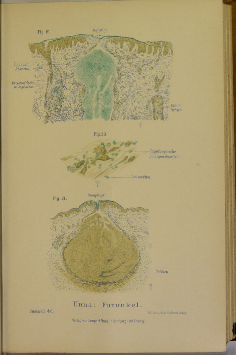 ■ ■: WB Kg. 1.9. Jnipetign. ilaarbalg - -- aj.p Abscess. Hypertrophische. Bmdegewebsz. '•'v; * Fig.20. ^ & - Jlvpertrophisrlie X-. Leukocvleti. soc 1. Fig.21. Hornjifropf Kokken. U nna: Fu r u nkel. Gummelt del Llth.AnsLJu!lu;K;inMarduetyzig