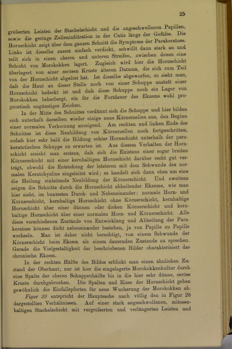 grölaerten Leisten der StacheLchieht nnd die aapsohwonenen PapUlen sowie die geringe Zellenindltration in der Cutis länge der Gefa ae. Die Horuschicht zeigt über dem ganzen Schnitt die Symptome der Parake»^ Links ist dieselbe zuerst einfach verdickt, schwillt dann stark an und teilt sich in einen oberen nnd unteren Streifen, zwischen denen eine Schicht von Morokokken lagert. Zugleich wird hier die Horuschicht überlagert von einer serösen Kruste älteren Datums, die eich -„Tel von der Homschicht abgelöst hat. Ist dieselbe abgeworfen, so s eht man dafs die Haut an dieser Stelle noch von einer Schuppe anstatt einer Hornschicht bedeckt ist und dafs diese Schuppe noch ein Lager von Morokokken beherbergt, ein für die Fortdauer des Ekzems wohl pro- gnostisch ungünstiges Zeichen. In der Mitte des Schnittes verdünnt sich die Schuppe und hier bilden sich unterhalb derselben wieder einige neue Körnerzellen aus, den Beginn einer normalen Verhornung anzeigend. Am rechten und linken Ende des Schnittes ist diese Neubildung von Körnerzellen noch fortgeschritten, sodafs hier sehr bald die Bildung echter Hornschicht unterhalb der para- keratotischen Schuppe zu erwarten ist. Aus diesem Verhalten der Horn- schicht ersieht man erstens, dafs sich die Existenz einer sogar breiten Körnerschicht mit einer kernhaltigen Hornschicht darüber recht gut ver- trägt, obwohl die Entstehung der letzteren mit dem Schwunde des nor- malen Keratohyalins eingeleitet wird; es handelt sich dann eben um eine die Heilung einleitende Neubildung der Körnerschicht. Und zweitens zeigen die Schnitte durch die Hornschicht abheilender Ekzeme, wie mau hier sieht, im buntesten Durch- und Nebeneinander: normale Horn- und Körnerschicht, kernhaltige Hornschicht ohne Körnerschicht, kernhaltige Hornschicht über einer dünnen oder dicken Körnerschicht und kern- haltige Hornschicht über einer normalen Horn- und Körnerschicht. Alle diese verschiedenen Zustände von Entwicklung und Abheilung der Para- keratose können dicht nebeneinander bestehen, ja von Papille zu Papille wechseln. Man ist daher nicht berechtigt, von einem Schwunde der Körnerschicht beim Ekzem als einem dauernden Zustande zu sprechen. Gerade die Vielgestaltigkeit der beschriebenen Bilder charakterisiert das chronische Ekzem. In der rechten Hälfte des Bildes erblickt man einen ähnlichen Zu- stand der Oberhaut; nur ist hier die eingelagerte Morokokkenkultur durch eine Spalte der oberen Schuppenhälfte bis in die hier sehr dünne, seröse Kruste durchgebrochen. Die Spalten und Bisse der Hornschicht geben gewöhnlich die Einfallspforten für neue Wucherung der Morokokken ab. Figur 29 entspricht der Hauptsache nach völlig den in Figur 28 dargestellten Verhältnissen. Auf einer stark angeschwollenen, mitosen- haltigen Stachelschicht mit vergröfserten und verlängerten Leisten und