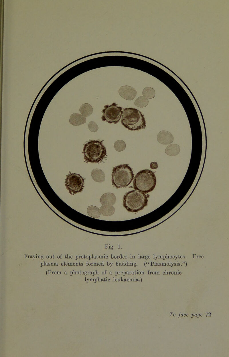 I’l-aying out of the protoplasmic border iu large lymphocytes. Free idasma elements formed by budding. (“ Plasmolysis.”) (From a photograph of a preparation from chronic lymphatic leukaemia.)