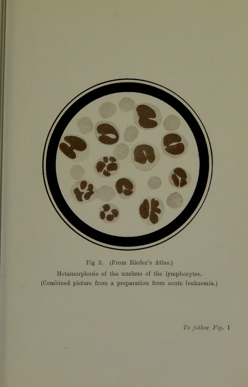 Fig 2. (From Eiecler’s Atlas.) Metamorphosis of the nucleus of the lymphocytes. (Combined picture from a preparation from acute leukaemia.) To follow Fig. 1