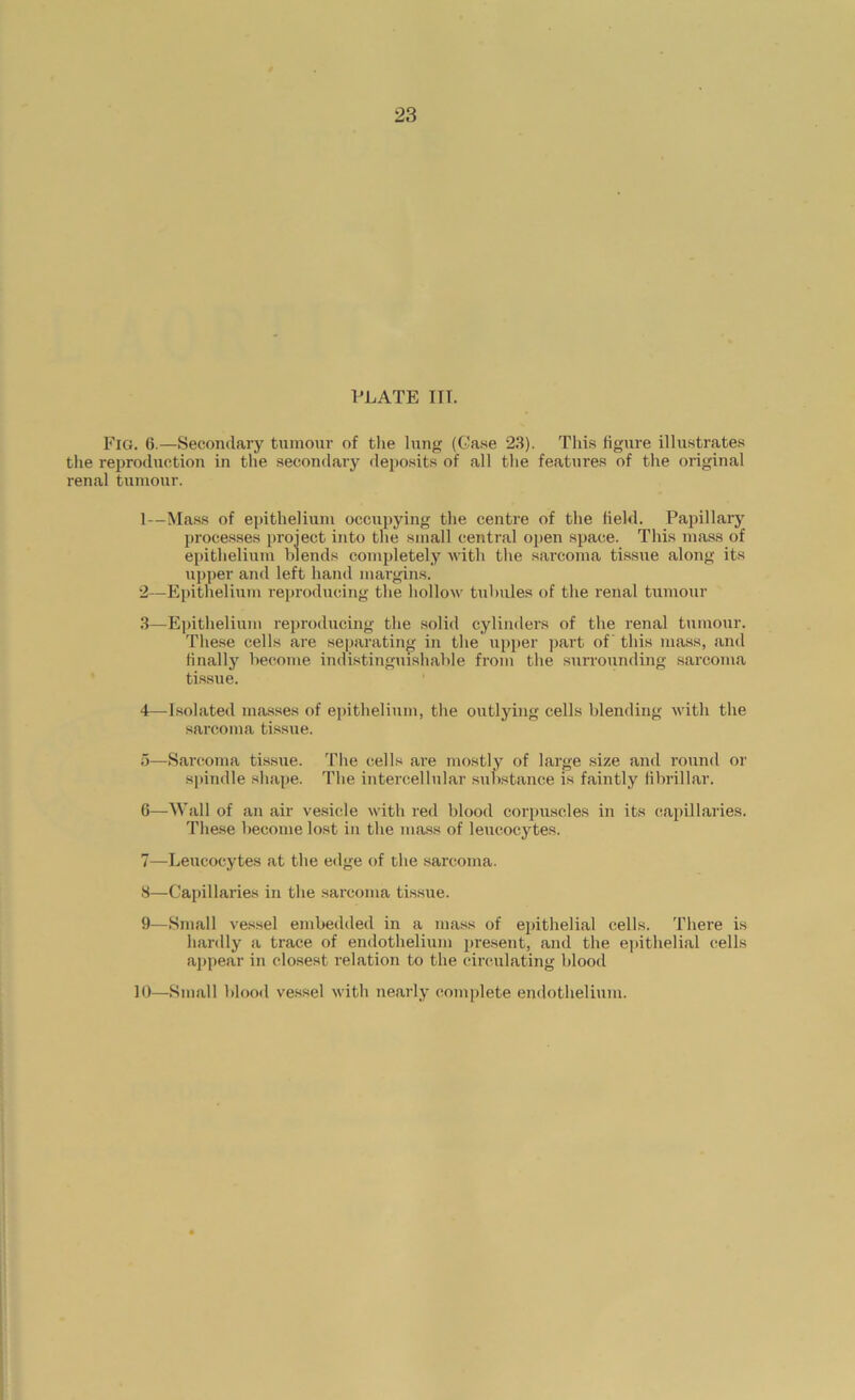 23 PLATE III. Eig. 6.—Secondary tumour of tlie lung (Case 23). This figure illustrates the reproduction in tlie secondary deposits of all the features of the original renal tumour. 1— Mass of epithelium occupying the centre of the held. Papillary processes project into the small central open space. This mass of epithelium blends completely with tlie sarcoma tissue along its upper and left hand margins. 2— Epithelium reproducing the hollow tubules of the renal tumour 3— Epithelium reproducing the .solid cylinders of the renal tumour. These cells are separating in the upjier part of this mass, and Hnally become indistinguishable from the surrounding sarcoma tissue. 4— Isolated ma.sses of epithelium, the outlying cells blending with the sarcoma tissue. 5— Sarcoma tissue. The cells are mostly of large size and round or spindle sh.ape. The intercellular sulVstance is faintly Hbrillar. 6— Wall of an air vesicle with red blood corpuscles in its capillaries. These become lost in the mass of leucocytes. 7— Leucocytes at the edge of the sarcoma. S—Capillaries in the sarcoma tissue. 9—Small ve.ssel embedded in a mass of epithelial cells. There is hardly a trace of endothelium present, and the ejiithelial cells appear in closest relation to the cinmlating blood 10—Small blood vessel with nearly complete endothelium. I