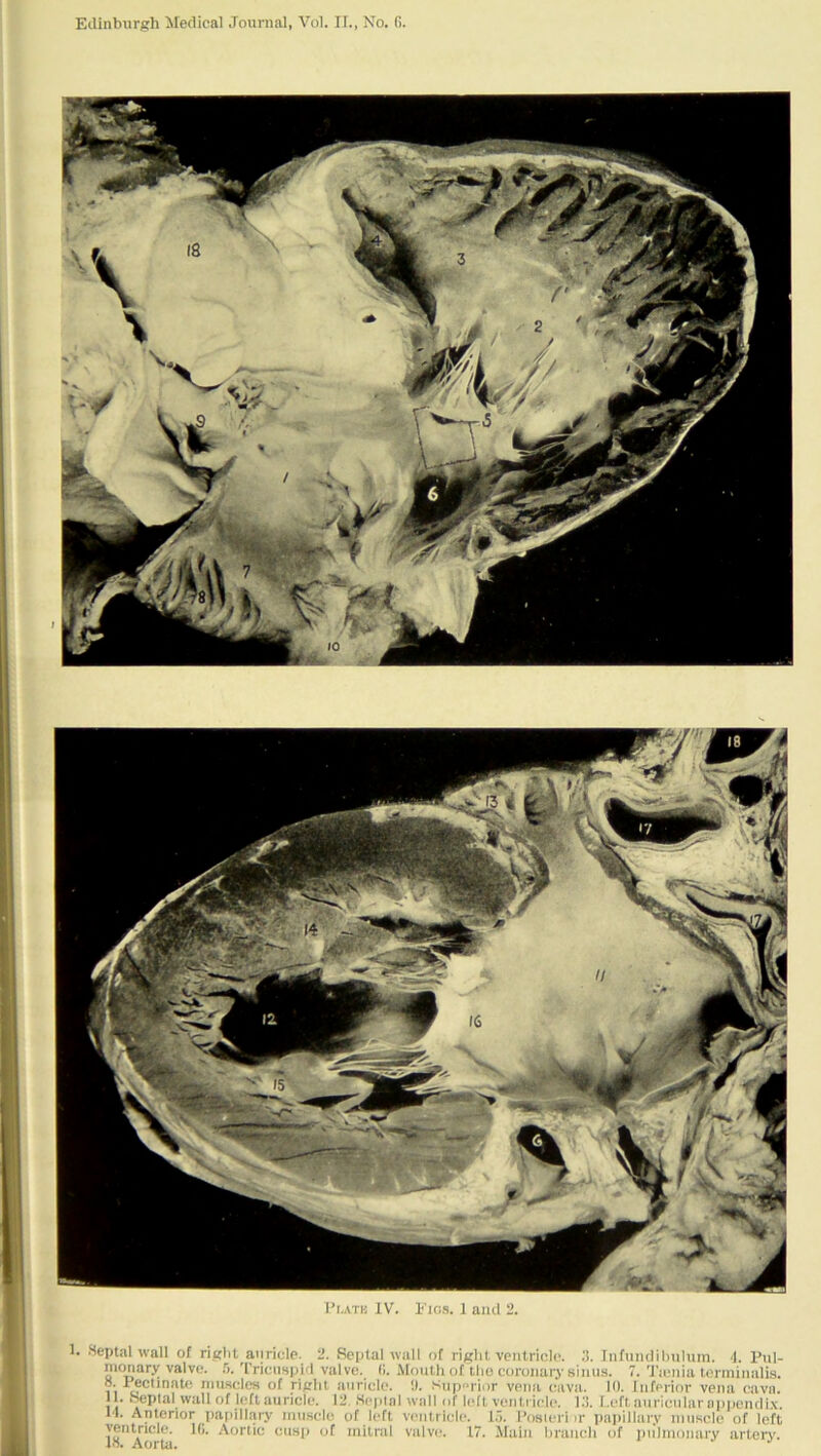 1’r.ATK IV. I'los. 1 and 2. 1. Heptal wall of rigtil aiiricle. 2. Septal wall of right ventricle. Infundibiihim. 4. Pul- monary valve. Tricuspid valve. (1. Mouth of the coronary sinus. 7. Tieuia tcrmiualis. , I'^ctinaU^ muscles of right auricle. !). Sup'^rior vena (;ava. 10. Inferior vena cava. H. f^plal wall of left auricle. 12. Seplal wall of left ventricle. I.'i. l.eft auricular ni)pendi.\. 11. Anterior papillary muscle of left ventricle. 1.7. I’osieri ir paiiillary muscle of left