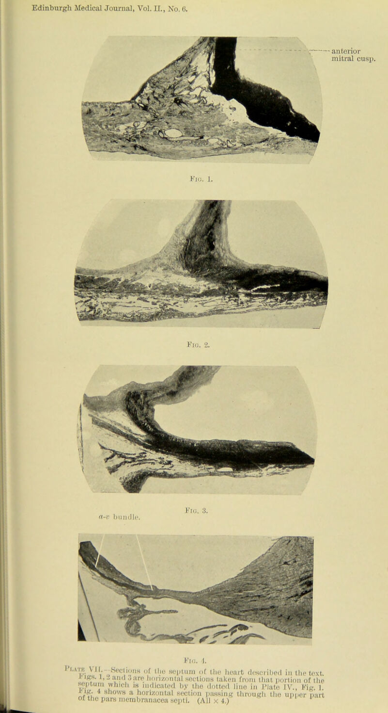 anterior mitral cusi). Eiii. 1. Fig. 2. n-i; bundle. Fro. 3. .,m VII. Seclioim of llio seiUuin of the heart deserihed in the text. 1 igs. 1,-aijd .jarp lioiizotilal Koetioiis taken from that i)ortion of the soptum which m nidicatod by tho doited line in I’lato l\\, Fig. 1. t'lg. 4 shows a horizoiilal seclion jiassing through the uniier pari