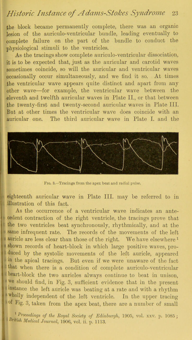 the block became permanently complete, there was an organic lesion of the auriculo-ventricular bundle, leading eventually to complete failure on the part of the bundle to conduct the physiological stimuli to the ventricles. As the tracings show complete auriculo-ventricular dissociation, it is to be expected that, just as the auricular and carotid waves sometimes coincide, so will the auricular and ventricular waves occasionally occur simultaneously, and we find it so. At times the ventricular wave appears quite distinct and apart from any other wave—for example, the ventricular wave between the eleventh and twelfth auricular waves in Plate II., or that between the twenty-first and twenty-second auricular waves in Plate III. But at other times the ventricular wave does coincide with an auricular one. The third auricular wave in Plate I. and the Fio. 3.—Tracings from the apex beat and radial pulse. eighteenth auricular wave in Plate III. may be referred to in illustration of this fact. As the occurrence of a ventricular wave indicates an ante- cedent contraction of the right ventricle, the tracings prove that the two ventricles beat synchronously, rhythmically, and at the same infrequent rate. The records of the movements of the left i auricle are less clear than those of the right. We have elsewhere ^ s shown records of heart-block in which large positive waves, pro- ; duced by the systolic movements of the left auricle, appeared in the apical tracings. But even if we were unaware of the fact ; that when there is a condition of complete auriculo-ventricular heart-block the two auricles always continue to beat in unison, ‘ we should find, in Pig. 3, sufficient evidence that in the present instance the left auricle was beating at a rate and with a rhythm •wholly independent of the left ventricle. In the upper tracing ’ 3, taken from the apex beat, there are a number of small ] foceedimjg of the Royal Society of Edinburgh, 1905, vol. xxv. j). 1085; ' oritwh Mediad Journal, 1900, vol. ii. p. 1113.