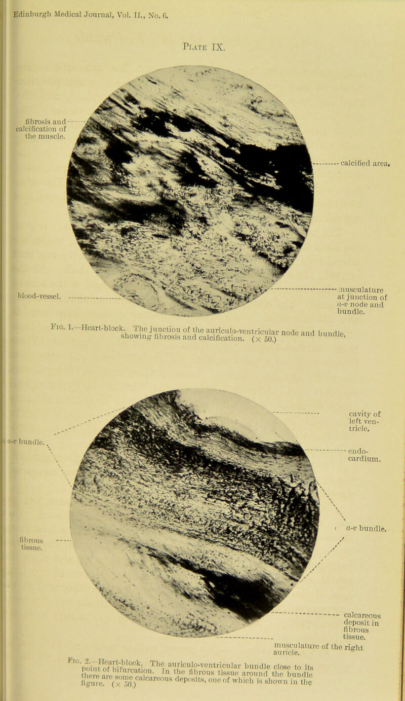 PbATE IX. fibrosis and--- ■ calcification of tlie muscle. blood-vessel. calcified area. • auisculature at junction of a-v node and bundle. Fig. 1.—Heart-block. The junction of the auriculo-ventricular showing fibrosis and calcification, (x 50.) node and bundle, a-r bundle. fibrous tissue. cavitj’ of left ven- tricle. — endo- cardium. I a-v bundle. - calcareous deposit in fibrous tissue. musculature of the right auricle. point'close to its ii.or« fibrous tissue around the bundle figure (T5(1)'' o'cef which is shown in the