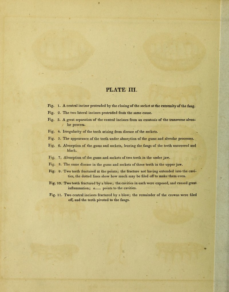 Fig. 1. A central incisor protruded by the closing of the socket at the extremity of the fang. Fig. 2. The two lateral incisors protruded from the same cause. Fig. 3. A great separation of the central incisors from an exostosis of the transverse alveo- / lar process. Fig. 4. Irregularity of the teeth arising from disease of the sockets. Fig. 5. The appearance of the teeth under absorption of the gums and alveolar processes. Fig. b. Absorption of the gums and sockets, leaving the fangs of the teeth uncovered and black. Fig. 7. Absorption of the gums and sockets of two teeth in the under jaw. Fig. 8. The same disease in the gums and sockets of three teeth in the upper jaw. Fig. 9. Two teeth fractured at the points; the fracture not having extended into the cavi- ties, the dotted lines show how much may be filed off to make them even. Fig, 10. Two teeth fractured by a blow; the cavities in each were exposed, and caused great inflammation; a points to the cavities. Fig. 11. Two central incisors fractured by a blow; the remainder of the crowns were filed off, and the teeth pivoted to the fangs.