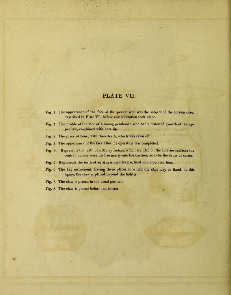 Fig. I. The appearance of the face of the person who was the subject of the antrum case, described in Plate VI. before any ulceration took place. Fig. 1. The profile of the face of a young gentleman who had a distorted growth of the up- per jaw, combined with hare lip. Fig. 2. The piece of bone, with three teeth, which was sawn off. Fig. 3. The appearance of the face after the operation was completed. Fig. 4. Represents the teeth of a Malay Indian, which are filed on the anterior surface; the central incisors were filed so nearly into the cavities, as to be the cause of caries. Fig. 5. Represents the teeth of an Abyssinian Negro, filed into a pointed form. Fig. 6. The key instrument, having three places in which the claw may be fixed: in this figure, the claw is placed beyond the bolster. Fig. 7. The claw is placed in the usual position. Fig. 8. The claw is placed before the bolster.