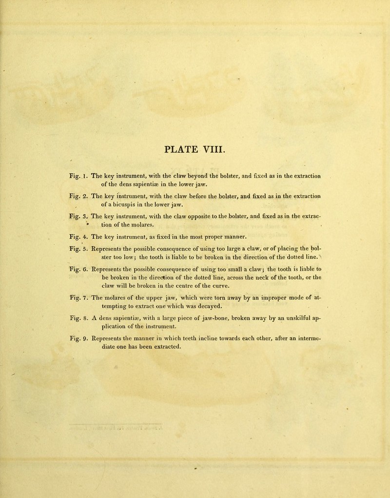 Fig. 1. Fig. 2. Fig. 3. Fig. 4. Fig. 5. Fig. 6. Fig. 7. Fig. 8. Fig. 9. The key instrument, with the claw beyond the bolster, and fixed as in the extraction of the dens sapientiae in the lower jaw. The key instrument, with the claw before the bolster, and fixed as in the extraction of a bicuspis in the lower jaw. The key instrument, with the claw opposite to the bolster, and fixed as in the extrac- tion of the molares. The key instrument, as fixed in the most proper manner. Represents the possible consequence of using too large a claw, or of placing the bol- ster too low; the tooth is liable to be broken in the direction of the dotted line. Represents the possible consequence of using too small a claw; the tooth is liable to be broken in the direction of the dotted line, across the neck of the tooth, or the claw will be broken in the centre of the curve. The molares of the upper jaw, which were torn away by an improper mode of at- tempting to extract one which was decayed. A dens sapientiae, with a large piece of jaw-bone, broken away by an unskilful ap- plication of the instrument. Represents the manner in which teeth incline towards each other, after an interme- diate one has been extracted.