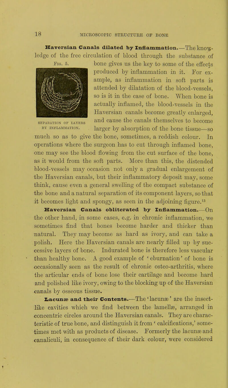 Haversian Canals dilated by Inflammation.—The know- ledge of the free circulation of blood through the substance of bone gives us the key to some of the effects produced by inflammation in it. For ex- ample, as inflammation in soft parts is attended by dilatation of the blood-vessels, so is it in the case of bone. When bone is actually inflamed, the blood-vessels in the Haversian canals become greatly enlarged, and cause the canals themselves to become larger by absorption of the bone tissue—so much so as to give the bone, sometimes, a reddish colour. In operations where the surgeon has to cut through inflamed bone, one may see the blood flowing from the cut surface of the bone, as it would from the soft parts. More than this, the distended blood-vessels may occasion not only a gradual enlargement of the Haversian canals, but their inflammatory deposit may, some think, cause even a general swelling of the compact substance of the bone and a natural separation of its component layers, so that it becomes light and spongy, as seen in the adjoining figure.13 Haversian Canals obliterated by Inflammation.—On the other hand, in some cases, e.g. in chronic inflammation, we sometimes find that bones become harder and thicker than natural. They may become as hard as ivory, and can take a polish. Here the Haversian canals are nearly filled up by suc- cessive layers of bone. Indurated bone is therefore less vascular than healthy bone. A good example of ‘ eburnation ’ of bone is •occasionally seen as the result of chronic osteo-arthritis, where the articular ends of bone lose their cartilage and become hard and polished like ivory, owing to the blocking up of the Haversian canals by osseous tissue. Iiacunae and their Contents.—The ‘ lacunae ’ are the insect- like cavities which we find between the lamella, arranged in concentric circles around the Haversian canals. They are charac- teristic of true bone, and distinguish it from ‘ calcifications,’ some- times met with as products of disease. Formerly the lacunae and canaliculi, in consequence of their dark colour, were considered Fig. 5. SEPARATION OF LAYERS BY INFLAMMATION.