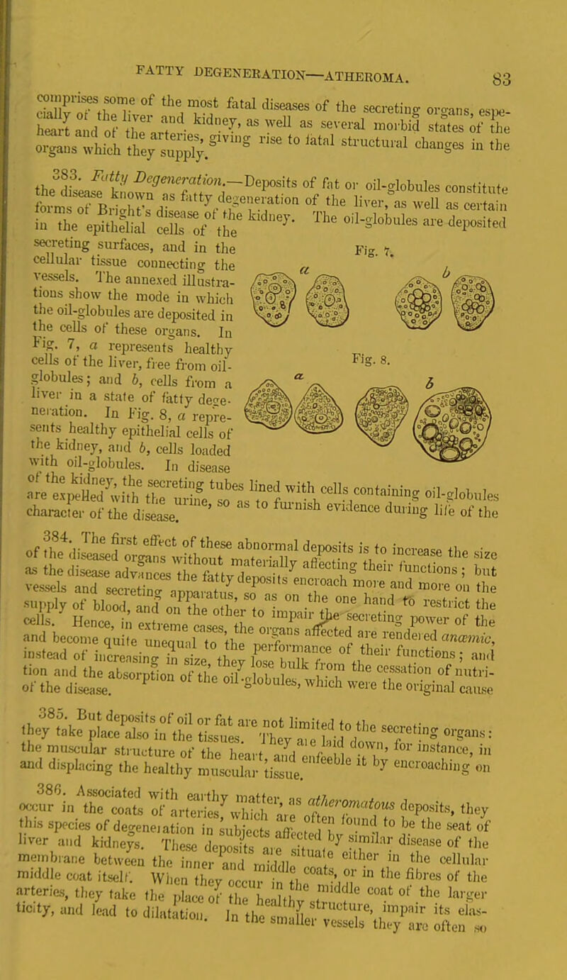 FATTY DEGENERATION—ATHEROMA. S3 comprises some of the most fatal diseases of the secreting- oro-ans wSl'Jjfcs*. %■ -«»- zws organs which they supply.8'2 * 10 iatal structlml flanges in the lheSd,Lf“S.S”T,?<* <» »r oil-globules constitute forms of 7generation of the liver, as well as certain in the e^hlV tta Th‘ 0il-*bb“ta *l»i'»' secreting surfaces, and in the Fi- - cellular tissue connecting the vessels. The annexed illustra- tions show the mode in which the oil-globules are deposited in the cells of these organs. Jn Fl,r 7! a rePresents healthy globules; and b, cells from a liver in a state of fatty de^e- ne'ation. in Fig. 8, a repre- sents healthy epithelial cells of the kidney, and 6, cells loaded with oil-globules. In disease and ioco,“ qu rteTudT’tho', Tf“ r T “<lel «—* instead of iucZli^L°.?! f rfonmnce of their functions; and they take placc'aTsfintte touM810 °W™e p!°,U sec''c,!nS organs; the muscular structure of the heart mfd J f n f°r stance, in and displacing the healthy muscular tissue ' ' 7 eucroachi‘>g on occur in the coats arteries7SfvJ f/ier°matous deposits, they this species of degeneiation in subjects °'Uld,to be the seat of liver and kidneys. These denosfi tf i ^7 ?\milar disease of the ntombrn,, be.wL the Sj?ZtJSuk£Z “‘ftf” *• '»*' ** - * «*&* fas'