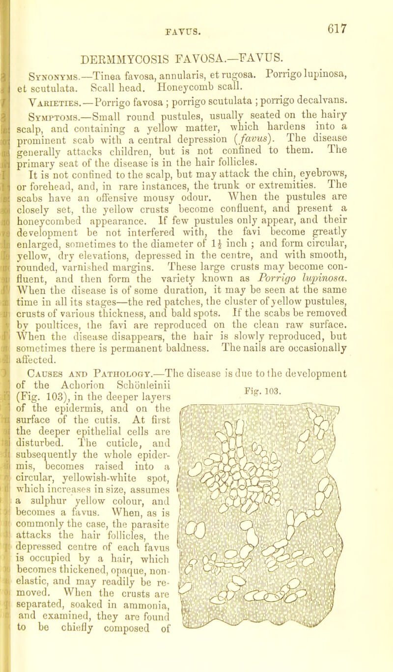 FATUS. DERMMYCOSIS FAVOSA.—FAVDS. Synonyms.—Tinea favosa, annularis, et rugosa. Porrigolupinosa, et scutulata. Scall head. Honeycomb scall. Varieties.—Porrigo favosa ; porrigo scutulata ; pomgo decalvans. SvMPTOsrs.—Small round pustules, usually seated on the hairy scalp, and containing a yellow matter, which hardens into a prominent scab with a central depression { favus). The disease generally attacks children, but is not confined to them. The primary seat of the disease is in the hair follicles. It is not confined to the scalp, but may attack the chin, eyebrows, or forehead, and, in rare instances, the trunk or extremities. The scabs have an offensive mousy odour. When the pustules are closely set, the yellow crusts become confluent, and present _a honeycombed appearance. If few pustules only appear, and their development be not interfered with, the favi become greatly enlarged, sometimes to the diameter of li inch ; and form circular, yellow, dry elevations, depressed in the centre, and with smooth, rounded, varnished margins. These large crusts may become con- fluent, antl then form the variety known as Porrigo liqnnosa. When the disease is of some duration, it may be seen at the same time in all its stages—the red patches, the cluster of yellow pustules, crusts of various thickness, and bald spots. If the scabs be removed by poultices, ihe favi are reproduced on the clean raw surface. When the disease disappears, the hair is slowly reproduced, but sometimes there is permanent baldness. The nails are occasionally affected. Causes and Pathology.—The disease is due to the development of the Achorion Schonleinii (Fig. 10.3), in the deeper layei's of the epidermis, and on the surface of the cutis. At first the deeper epithelial cells are disturbed. The cuticle, and subsequently the whole epider- mis, becomes raised into a circular, yellowish-white spot, ■which increases in size, assumes a sulphur yellow colour, and becomes a favus. When, as is commonly the case, the parasite attacks the hair follicles, the depressed centre of each favus is occupied by a hair, which becomes thickened, opaque, non- elastic, and may readily be re- moved. When the crusts are separated, soaked in ammonia, and examined, they are found to be chiefly composed of