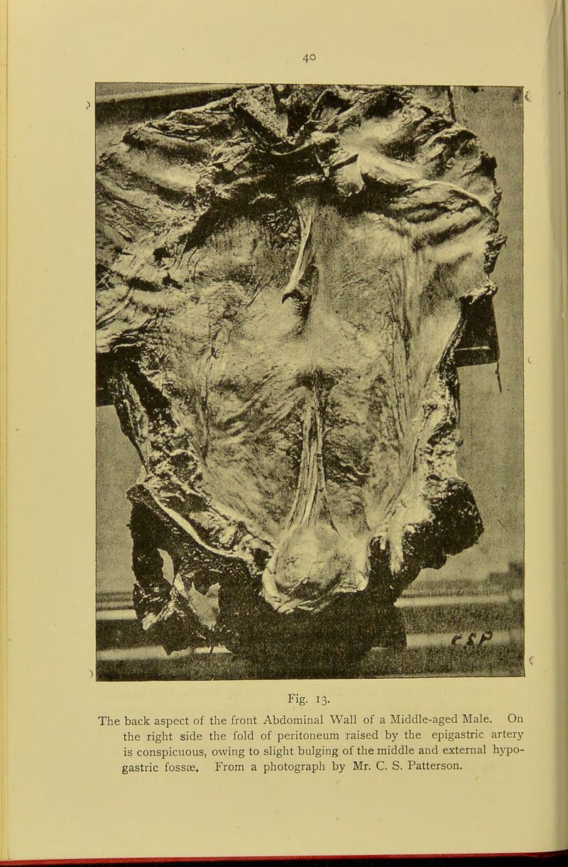 Fig. 13- The back aspect of the front Abdominal Wall of a Middle-aged Male. On the right side the fold of peritoneum raised by the epigastric artery is conspicuous, owing to slight bulging of the middle and external hypo- gastric fossae. From a photograph by Mr. C. S. Patterson.