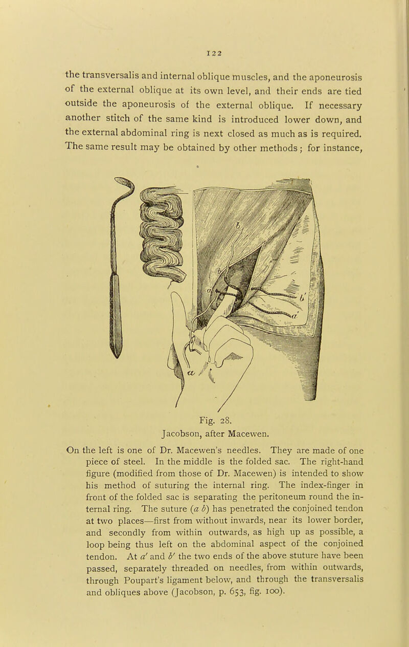the transversalis and internal oblique muscles, and the aponeurosis of the external oblique at its own level, and their ends are tied outside the aponeurosis of the external oblique. If necessary another stitch of the same kind is introduced lower down, and the external abdominal ring is next closed as much as is required. The same result may be obtained by other methods ; for instance, Fig. 28. Jacobson, after Macewen. On the left is one of Dr. Macewen's needles. They are made of one piece of steel. In the middle is the folded sac. The right-hand figure (modified from those of Dr. Macewen) is intended to show his method of suturing the internal ring. The index-finger in front of the folded sac is separating the peritoneum round the in- ternal ring. The suture (a b) has penetrated the conjoined tendon at two places—first from without inwards, near its lower border, and secondly from within outwards, as high up as possible, a loop being thus left on the abdominal aspect of the conjoined tendon. At a' and b' the two ends of the above stuture have been passed, separately threaded on needles, from within outwards, through Poupart's ligament below, and through the transversalis and obliques above (Jacobson, p. 653, fig. 100).