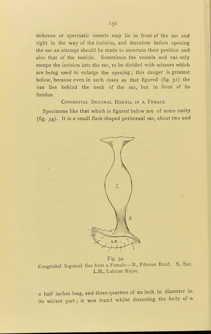 i5° deferens or spermatic vessels may lie in front of the sac and right in the way of the incision, and therefore before opening the sac an attempt should be made to ascertain their position and also that of the testicle. Sometimes the vessels and vas only escape the incision into the sac, to be divided with scissors which are being used to enlarge the opening; this danger is greatest below, because even in such cases as that figured (fig. 32) the vas lies behind the neck of the sac, but in front of its fundus. Congenital Inguinal Hernia in a Female. Specimens like that which is figured below are of some rarity (fig. 34). It is a small flask-shaped peritoneal sac, about two and Fig. 34- Congenital Inguinal Sac from a Female.—B., Fibrous Band. S., Sac. L.M., Labium Major. a half inches long, and three-quarters of an inch in diameter i its widest part; it was found whilst dissecting the body of