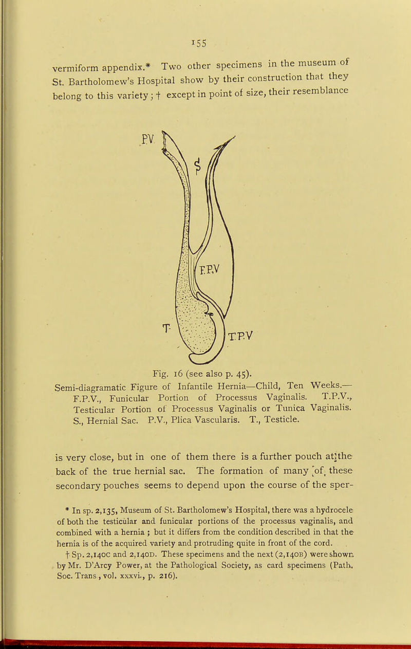 vermiform appendix * Two other specimens in the museum of St. Bartholomew's Hospital show by their construction that they belong to this variety; f except in point of size, their resemblance TP-V Fig. 16 (see also p. 45). Semi-diagramatic Figure of Infantile Hernia—Child, Ten Weeks.— F.P.V., Funicular Portion of Processus Vaginalis. T.P.V., Testicular Portion of Processus Vaginalis or Tunica Vaginalis. S., Hernial Sac. P.V., Plica Vascularis. T, Testicle. is very close, but in one of them there is a further pouch atHhe back of the true hernial sac. The formation of many 'of these secondary pouches seems to depend upon the course of the sper- * In sp. 2,135, Museum of St. Bartholomew's Hospital, there was a hydrocele of both the testicular and funicular portions of the processus vaginalis, and combined with a hernia ; but it differs from the condition described in that the hernia is of the acquired variety and protruding quite in front of the cord. t'Sp. 2,140c and 2,1400. These specimens and the next (2,14013) wereshown. by Mr. D'Arcy Power, at the Pathological Society, as card specimens (Path. Soc. Trans , vol. xxxvi., p. 216).