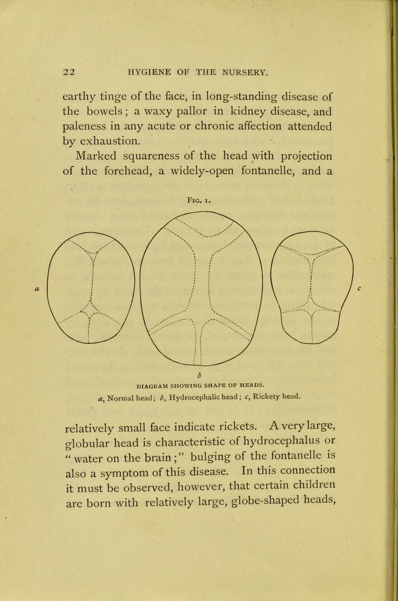 earthy tinge of the face, in long-standing disease of the bowels ; a waxy pallor in kidney disease, and paleness in any acute or chronic affection attended by exhaustion. Marked squareness of the head with projection of the forehead, a widely-open fontanelle, and a Fig. i. a, Normal head; b, Hydrocephalic head ; c, Rickety head. relatively small face indicate rickets. A very large, globular head is characteristic of hydrocephalus or “ water on the brain ; ” bulging of the fontanelle is also a symptom of this disease. In this connection it must be observed, however, that certain children are born with relatively large, globe-shaped heads,