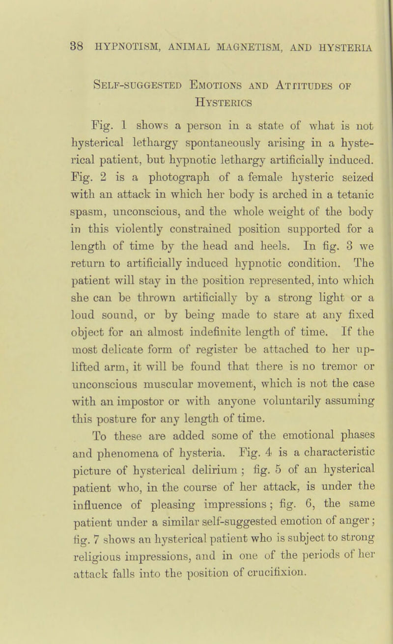 Self-suggested Emotions and Attitudes of Hysterics Fig. 1 shows a person in a state of what is not hysterical lethargy spontaneously arising in a hyste- rical patient, but hj^Duotic lethargy artificially induced. Fig. 2 is a photograph of a female hysteric seized with an attack in which her body is arched in a tetanic spasm, unconscious, and the whole weight of the body in this violently constrained position supported for a length of time by the head and heels. In fig. 3 we return to artificially induced hypnotic condition. The patient will stay in the position represented, into which she can be thrown artificially by a strong light or a loud sound, or by being made to stare at any fixed object for an almost indefinite length of time. If the most delicate form of register be attached to her up- lifted arm, it will be found that there is no tremor or unconscious muscular movement, which is not the case with an impostor or with anyone voluntarily assuming this posture for any length of time. To these are added some of the emotional phases and phenomena of hysteria. Fig. 4 is a characteristic picture of hysterical delirium ; fig. 5 of an hysterical patient who, in the course of her attack, is under the influence of pleasing impressions; fig. 6, the same patient under a similar self-suggested emotion of anger; fig. 7 shows an hysterical patient who is subject to strong religious impressions, and in one of the periods of her attack falls into the position of crucifixion.
