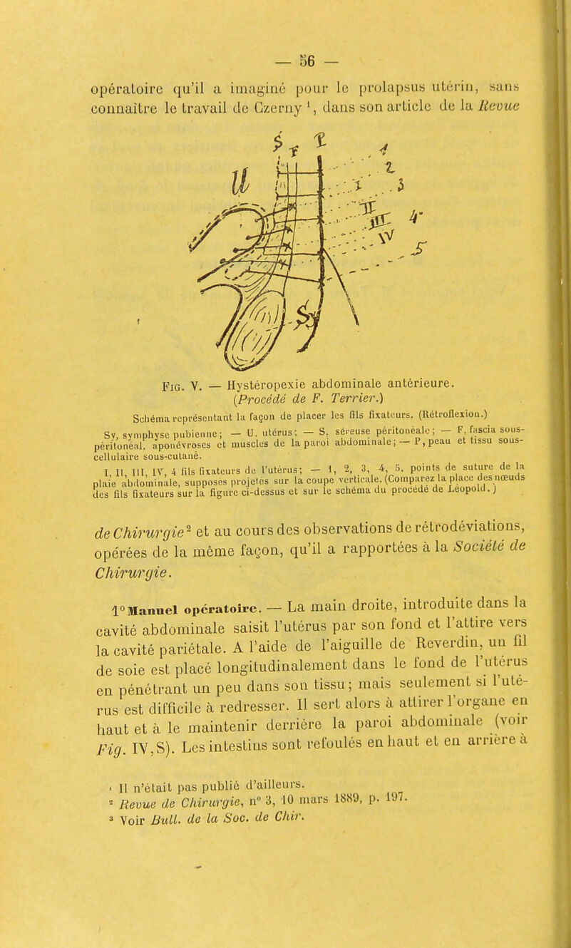 — 86 - opératoire qu'il a imaginé pour le prolapsus utérin, sans conaaitre le travail de Gzeriiy ', dans son article de la lieme Yia, V. — Hysléropexie abdominale antérieure. {Procédé de F. Terrier.) Schéma ropi'ésciitant la façon de placer les Dis fixateurs. (Rétrofieiiou.) Sv, symphyse pubienne; - U. utérus: - S, séreuse pèritonèale; - F fascia sous- périVonkl aponévroses et muscles de la paroi abdominale;-P,peau et Ussu sous- cellulaire sous-cutaué. I 11 III, IV, 4 fils fixateurs do l'utérus; - 1, 2. 3, 4, 5. points de suture de la plaie abdominale, supposés projetés sur la coupe vc^rticale (Comparez la place des nœuds des fils fixateurs sur la figure ci-dessus et sur le schéma du procédé de Leopold. J de Chirurgie^ et au cours des observations de rétrodéviations, opérées de la même façon, qu'il a rapportées à la Société de Chirurgie. l°Maimel opératoire. — La main droite, introduite dans la cavité abdominale saisit l'utérus par son fond et l'attire vers la cavité pariétale. A l'aide de l'aiguille de Reverdm, un fU de soie est placé longitudinalement dans le fond de l'utcrus en pénétrant un peu dans son tissu; mais seulement si l'uté- rus est difficile h redresser. 11 sert alors à attirer l'organe en haut et à le maintenir derrière la paroi abdominale (voir Fig. IV, S). Les intestins sont refoulés en haut et en arrière a ■ 11 n'était pas public d'ailleurs. = Revue de Chirurgie, n 3, 10 mars 1889. p. 197. ' Voir Bull, de la Soc. de Chir.