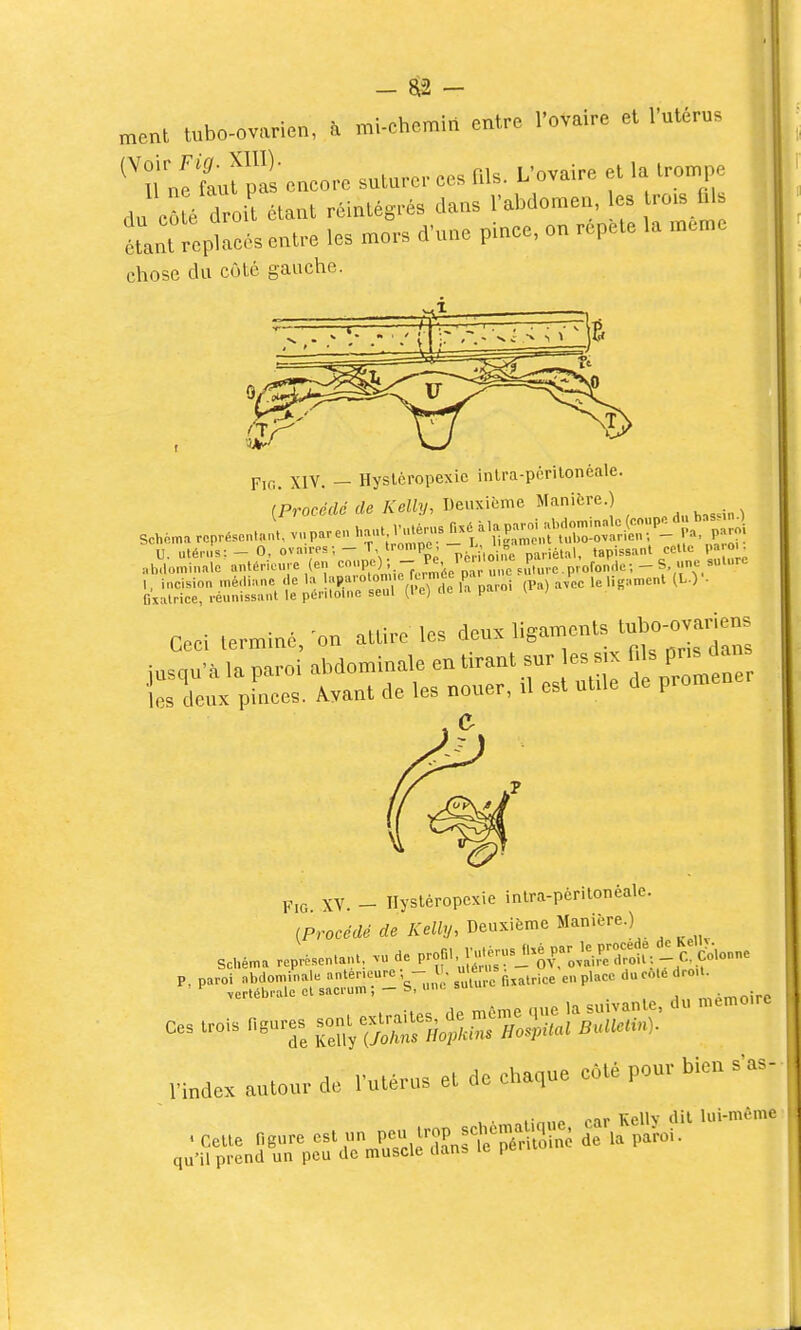 - ^ - „,enl tubo-ovarien, à mi-chemin entre l'ovaire et l'utérus ^trU'L^ encore suturer ce. nis. L'ovaire et la trompe du cS é cl oH étant réintégrés dans l'abdomen, les tro.s fils étant replacés entre les mors d'une pince, on répète la même chose du côté gauche. FiG. XIV. — Hyslèropexic inlra-pôrilonéale. '^Procédé de Kelly, Deuxième Manière.) ,, incision .né<li.u,c t e la l-^w^ Tparoi (Pa) avec lelig;.r fixatrice, réunissant le péritoine seul (le) «e pa v Ceci terminé,'on attire les ^eux ligaments tubo o-^^^^^^^^ jusqu'à la paroi abdominale en tirant sur es s x ^^^^^^J^^ ies deux pinces. Àvant de les nouer, û est ulde de promené e FiG XY. - Ilysléropcxie intra-périlonèale. iProcédé de Kelly, Deuxième Manière.) schéma représentant, .u de P^'' î^l^fl-^^lr o'^J^^M ^ cJ.onne ^-''i:;^::^::^'^:'- V-nl- su'ttre r^atrice en place du coté dro... l'index autour de l'utérus et de chaque côté pour bien s'as- . Ceue ngure est un ^Z^^^^ ^ ''^'^ qu'il prend un peu de muscle danb le pei