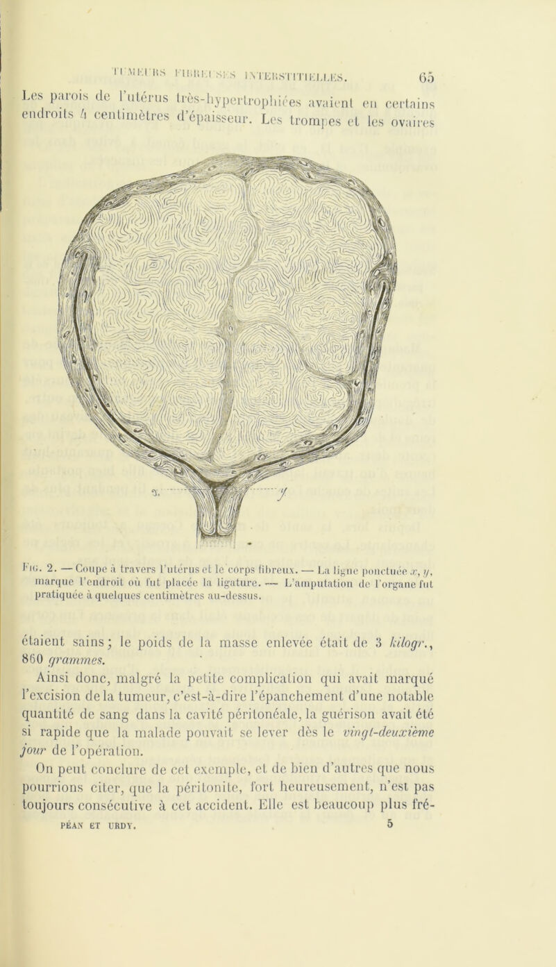 Les parois de l’utérus endroits l\ centimètres tiès-hypertrophiees avaient en certains d épaisseur. Les trompes et les ovaires Fa;. 2. — Coupe à travers l’utérus et le corps fibreux. — La ligne ponctuée x, marque l’endroit où fut placée la ligature.— L’amputation de l’organe fut pratiquée à quelques centimètres au-dessus. étaient sains; le poids de la masse enlevée était de 3 kilogr., 860 grammes. Ainsi donc, malgré la petite complication qui avait marqué l’excision delà tumeur, c’est-à-dire l’épanchement d’une notable quantité de sang dans la cavité péritonéale, la guérison avait été si rapide que la malade pouvait se lever dès le via g (-deuxième jour de l’opération. On peut conclure de cet exemple, et de bien d’autres que nous pourrions citer, que la péritonite, fort heureusement, n’est, pas toujours consécutive à cet accident. Elle est beaucoup plus fré- PEAN ET URDY.