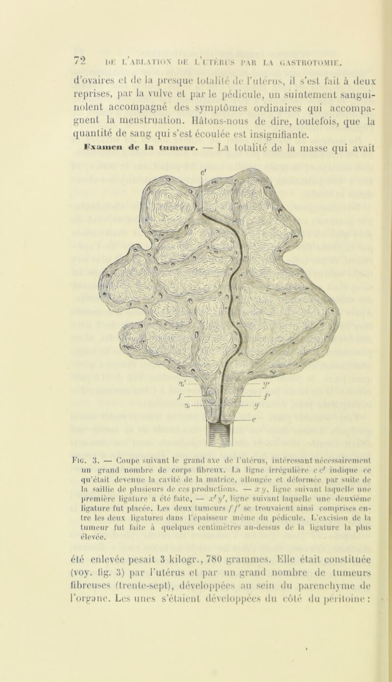 d ovaires et de la presque totalité de l’uférus, il s’est l’ait à deux reprises, par la vulve eL parle pédicule, un suintement sangui- nolent accompagné des symptômes ordinaires qui accompa- gnent la menstruation. Hâtons-nous de dire, toutefois, que la quantité de sang qui s’est écoulée est insignifiante. l'xumcn de la tumeur, — T,a totalité de la masse qui avait Fig. 3. — Coupe suivant le grand axe de F utérus, intéressant nécessairement un grand nombre de corps fibreux. La ligne irrégulière ce1 indique ce qu’était devenue la cavité de la matrice, allongée et déformée par suite de la saillie de plusieurs de ces productions. — x,y, ligne suivant laquelle une première ligature a été faite, — x'?/, ligne suivant laquelle une deuxième ligature fut placée. Les deux tumeurs f‘ f se trouvaient ainsi comprises en- tre les deux ligatures dans l’épaisseur même du pédicule. L'excision de la tumeur fut faite à quelques centimètres au-dessus de la ligature la plus élevée. été enlevée pesait 3 kiloger. ,780 grammes. Elle était constituée (voy. lig. 3) par l’utérus et par un grand nombre de tumeurs fibreuses (trente-sept), développées au sein du parenchyme de l’organe. Les unes s’étaient développées du côté du péritoine: