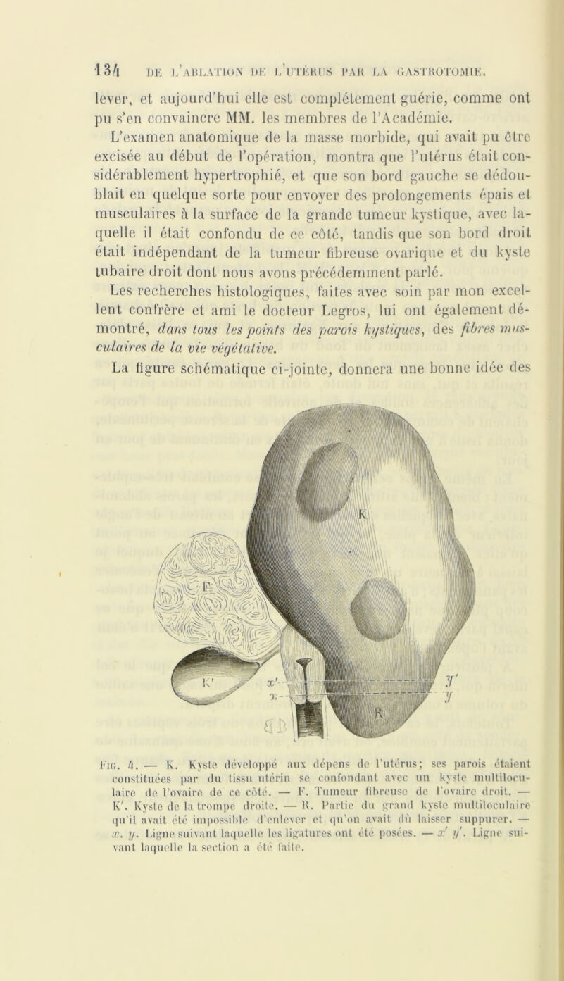 lever, et aujourd’hui elle est complètement guérie, comme ont pu s’en convaincre MM. les membres de l’Académie. L’examen anatomique de la masse morbide, qui avait pu être excisée au début de l’opération, montra que l’utérus était con- sidérablement hypertrophié, et que son bord gauche se dédou- blait en quelque sorte pour envoyer des prolongements épais et musculaires à la surface de la grande tumeur kystique, avec la- quelle il était confondu de ce côté, tandis que son bord droit était indépendant de la tumeur fibreuse ovarique et du kyste tubaire droit dont nous avons précédemment parlé. Les recherches histologiques, faites avec soin par mon excel- lent confrère et ami le docteur Legros, lui ont également dé- montré, dans tous las points des parois kystiques, des fibres mus- culaires de la vie végétative. La figure schématique ci-jointe, donnera une bonne idée des Fig. h. — K. Kyste développé aux dépens de l’utérus; ses parois étaient constituées par du tissu utérin se confondant avec un kyste multilocu- laire de l’ovaire de ce côté. — F. Tumeur fibreuse de l’ovaire droit. — K'. Kyste de la trompe droite. — R. Partie du grand kyste multiloculaire qu’il avait été impossible d’enlever et qu’on avait dû laisser suppurer. — x. y. Ligne suivant laquelle les ligatures ont été posées, —x' y'. Ligne sui- vant laquelle la section a été faite.