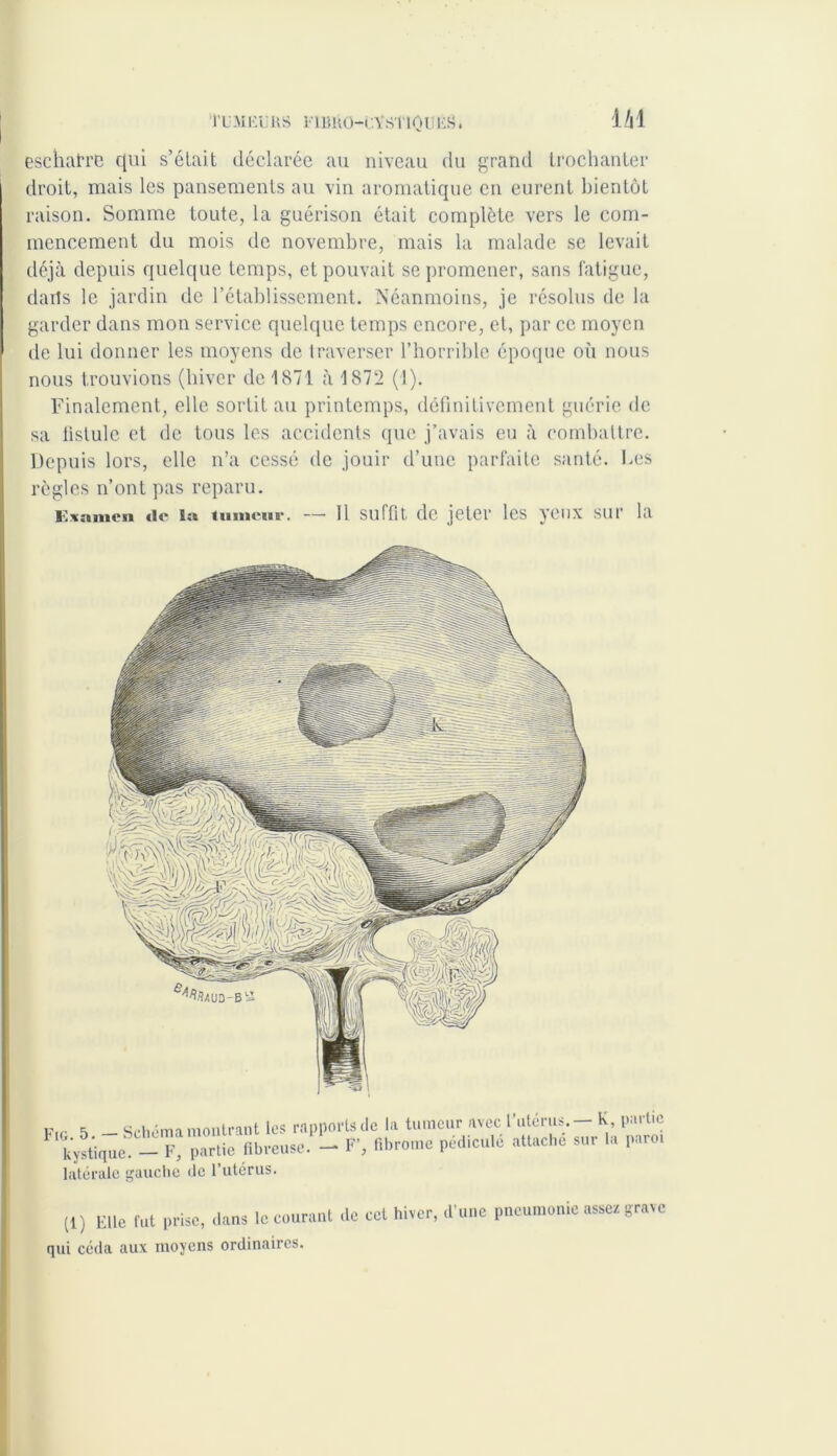 ÎUMliUUS ]•' ÎBHO-C.YSl'lQUESi iZil eschafre qui s’était déclarée au niveau du grand trochanter droit, mais les pansements au vin aromatique en eurent bientôt raison. Somme toute, la guérison était complète vers le com- mencement du mois de novembre, mais la malade se levait déjà depuis quelque temps, et pouvait se promener, sans fatigue, darîs le jardin de l’établissement. Néanmoins, je résolus de la garder dans mon service quelque temps encore, et, par ce moyen de lui donner les moyens de traverser l’horrible époque où nous nous trouvions (hiver de 1871 à 1872 (1). Finalement, elle sortit au printemps, définitivement guérie de sa fistule et de tous les accidents que j’avais eu à combattre. Depuis lors, elle n’a cessé de jouir d’une parfaite santé. Des règles n’ont pas reparu. Iranien «le la tumeur. —• Il Suffit de jeter les yCUX SUT la K.r - Schéma montrant les rapports de la tumeur avec l'utérus. — K partie k^ique - f partie fibreuse. - F’, fibrome pédicule attache sur la parer latérale gauche de l’utérus. (1) Elle fut prise, dans le courant de cet hiver, qui céda aux moyens ordinaires. d’une pneumonie assez grave