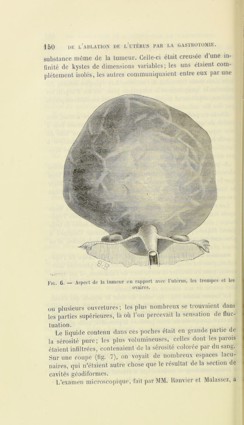 substance même de la tumeur. Celle-ci était creusée d’une in- finité de kystes de dimensions variables; les uns étaient com- plètement isolés, les autres communiquaient entre eux par une pIG. 6. _ Aspect de la tumeur en rapport avec l’utérus, les trompes et les ovaires. ou plusieurs ouvertures; les plus nombreux se trouvaient dans les parties supérieures, là où l’on percevait la sensation de fluc- tuation. Le liquide contenu dans ces poches était en grande partie de la sérosité pure; les plus volumineuses, celles dont les parois étaient infiltrées, contenaient de la sérosité colorée par du sang. Sur une coupe (fig. 7), on voyait de nombreux espaces lacu- naires, qui n’étaient autre chose que le résultat de la section de cavités géodiformes. L’examen microscopique, fait par MM. Ranvier et Malassez, a