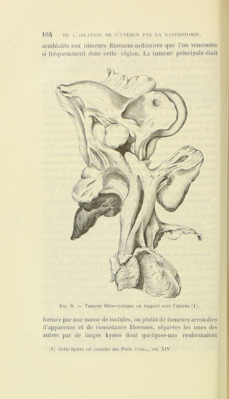 semblable aux tumeurs fibreuses ordinaires que l’on rencontre si fréquemment dans cette région. La tumeur principale était Fig. 9. — Tumeur fibro-cystique eu rapport avec l’utérus (1). formée par une masse de nodules, ou plutôt de tumeurs arrondies d’apparence et de consistance fibreuses, séparées les unes des autres par de larges kystes dont quelques-uns renfermaient (1) Cette figure est extraite des Path. frans., vol. XIV.