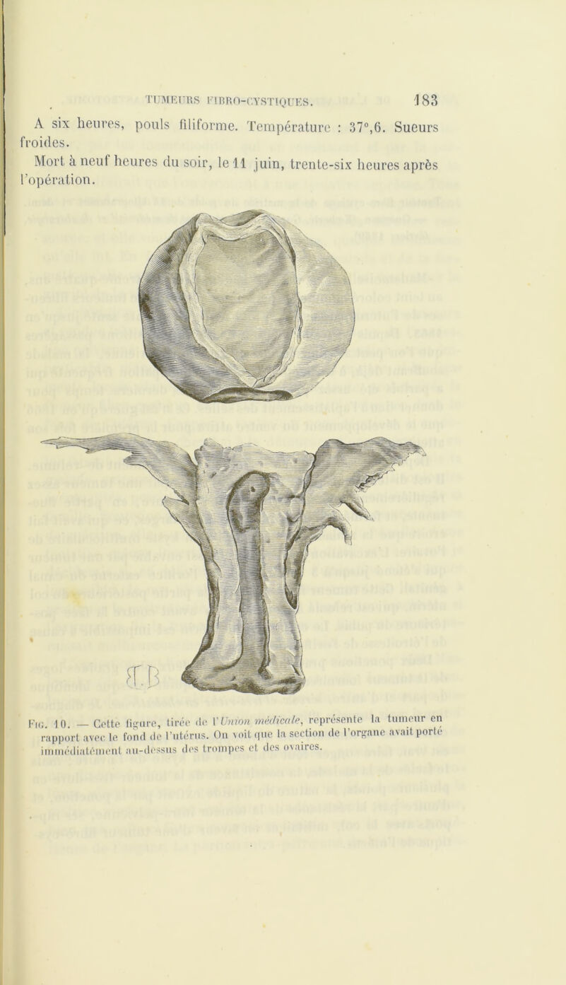 A six heures, pouls Filiforme. Température : 37°,6. Sueurs froides. Mort à neuf heures du soir, le 11 juin, trente-six heures après l’opération. Pi,; io Cette figure, tirée de Y Union médicale, représente la tumeur en rapport avec le fond de l’utérus. On voit que la section de l’organe avait porté immédiatement au-dessus des trompes et des ovaires.