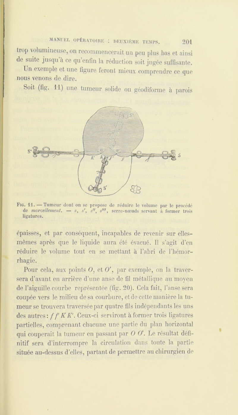MA NI RL OPÉRATOIRE : DEUX I RM R TEMPS trop volumineuse, on recommencerait un peu plus bas et ainsi de suite jusqu à ce qu enfin la réduction soit jugée suffisante. Un exemple et une figure feront mieux comprendre ce que nous venons de dire. Soit (fig. Ul) une tumeur solide ou géodiforme à parois Fig. 11. — Tumeur dont on se propose de réduire le volume par le procédé de morcellement. — s, sr, s, s’, serre-nœuds servant à former trois ligatures. épaisses, et par conséquent, incapables de revenir sur elles- mêmes après que le liquide aura été évacué. Tl s’agit d’en réduire le volume tout en se mettant à l’abri de l’hémor- rhagie. Pour cela, aux points O, et O', par exemple, on la traver- sera d’avant en arrière d’une anse de fil métallique au moyen de l’aiguille courbe représentée (fig. 20). Cela fait, l’anse sera coupée vers le milieu de sa courbure, et de cette manière la tu- meur se trouvera traversée par quatre fils indépendants les uns des autres: f f KK'. Ceux-ci serviront à former trois ligatures partielles, comprenant chacune une partie du plan horizontal qui couperait la tumeur en passant par O ()'. Le résultat défi- nitif sera d'interrompre la circulation dans toute la partie située au-dessus d’elles, partant de permettre au chirurgien de S’