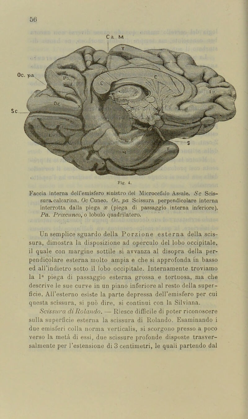 Ca M Faccia interna dell’emisfero sinistro del Microcefalo Assale. Sc Scis- sura.calcarina. Oc Cuneo. Oc. pa Scissura perpendicolare interna interrotta dalla piega x (piega di passaggio interna inferiore). Pa. Prcecuneo, o lobulo quadrilatero. Un semplice sguardo della Porzione esterna della scis- sura, dimostra la disposizione ad operculo del lobo occipitale, il quale con margine sottile si avvanza al disopra della per- pendicolare esterna molto ampia e che si approfonda in basso ed all’indietro sotto il lobo occipitale. luternamente troviamo la 1® piega di passaggio esterna grossa e tortuosa, ma che descrive le sue curve in un piano inferiore al resto della super- ficie. All’esterno esiste la parte depressa dell’emisfero per cui qnesta scissura, si puo dire, si contiriui con la Silviana. Scissura di Rolando. — Riesce difficile di poter riconoscere sulla superficie esterna la scissura di Rolando. Esaminando i due emisferi colla norma verticalis, si scorgono presso a poco verso la meta di essi, due scissure profonde disposte trasver- salniente per I’estensione di 3 centiinetri, le quali partendo dal