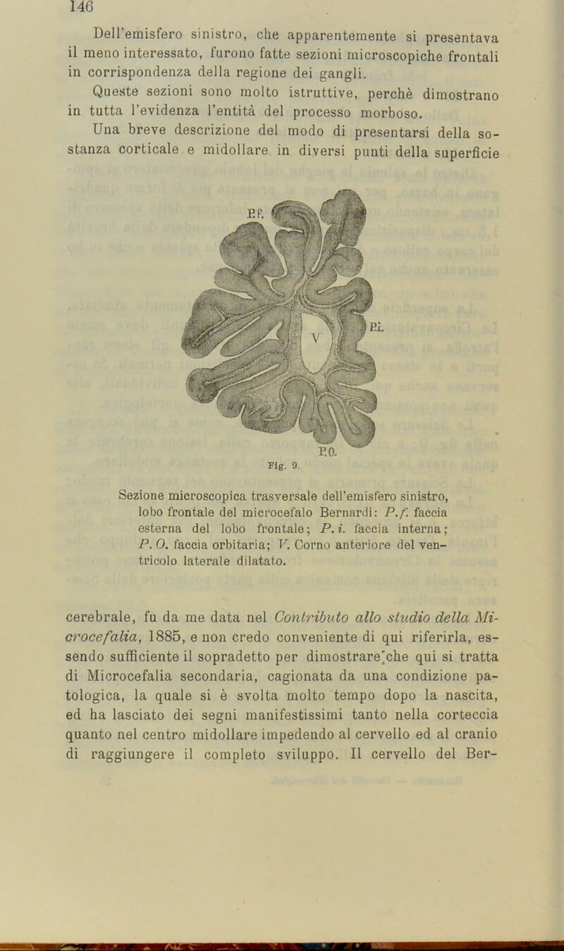 Dell’emisfero sinistro, die apparentemente si presentava il raeno interessato, furono fatte sezioni microscopiche frontali in corrispondenza della regione dei gangli. Queste sezioni sono niolto istruttive, perche dimostrano in tutta I’evidenza I’entita del processo morboso. Una breve descrizione del modo di presentarsi della so- stanza corticale e midollare in diversi punti della superfide Fig. 9. Sezione microscopica trasversale dell’emisfero sinistro, lobo frontale del microcefalo Bernardi: P.f. faccia esterna del lobo frontale; P. i. faccia interna; P. 0. faccia orbitaria; V. Corno anteriore del ven- tricolo laterale dilatato. cerebrale, fu da me data nel Conlributo alio studio della Mi- crocefalia, 1885, e non credo conveniente di qui riferirla, es- sendo sufficiente il sopradetto per dimostrare'che qui si ti’atta di Microcefalia secondaria, cagionata da una condizione pa- tologica, la quale si e svolta niolto tempo dopo la nascita, ed ha lasciato dei segni inanifestissiini tanto nella corteccia quanto nel centre midollare impedendo al cervello ed al cranio di raggiungere il complete sviluppo. Il cervello del Ber-