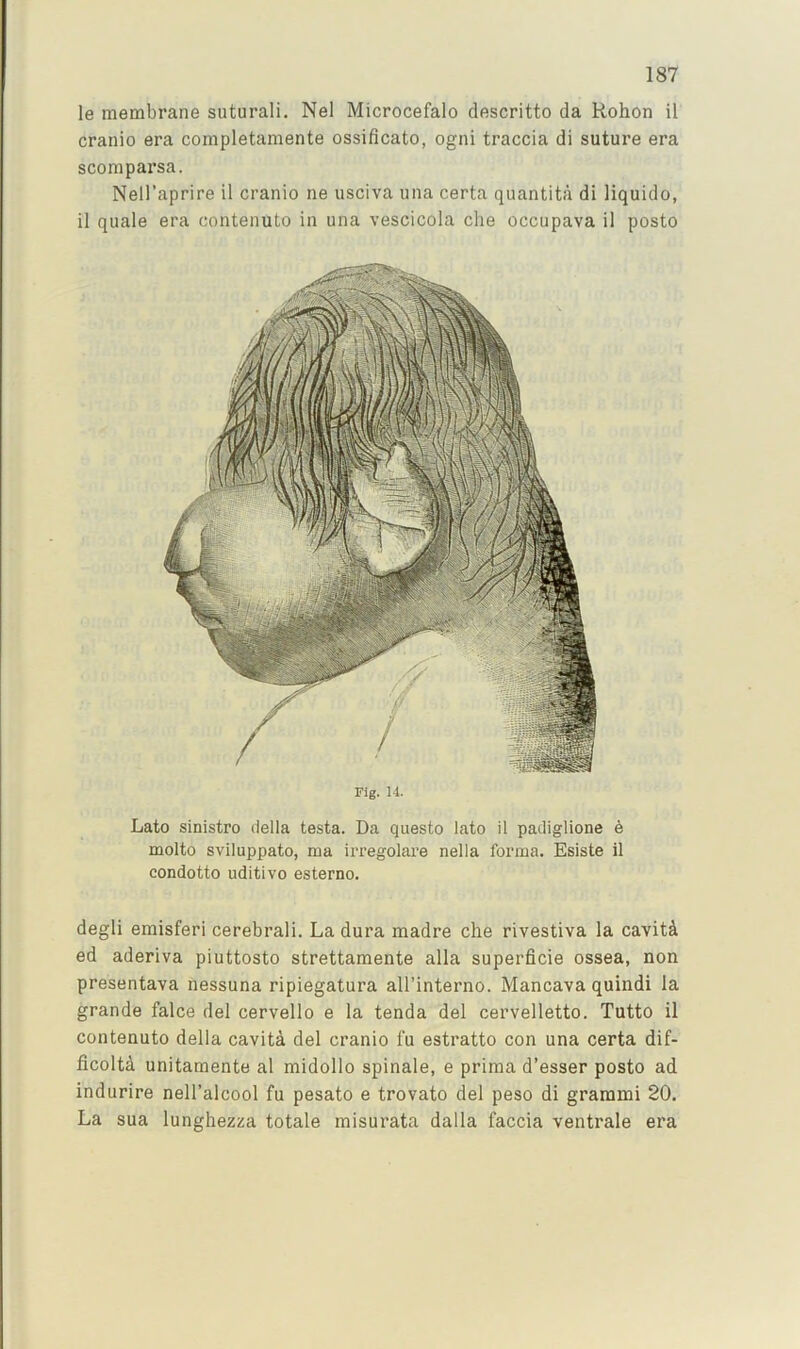 le membrane suturali. Nel Microcefalo descritto da Rohon il cranio era completamente ossificato, ogni traccia di suture era scompai’sa. Nell’aprire il cranio ne usciva una certa quantita di liquido, il quale era contenuto in una vescicola die occupava il posto Fig. 14. Lato sinistro della testa. Da questo lato il padiglione 6 molto sviluppato, ma iiTegolare nella forma. Esiste il condotto uditivo esterno. degli emisferi cerebral!. La dura madre die rivestiva la cavitA ed aderiva piuttosto strettamente alia superficie ossea, non presentava nessuna ripiegatura all’interno. Mancava quindi la grande falce del cervello e la tenda del cervelletto. Tutto il contenuto della cavita del cranio fu estratto con una certa dif- ficoltd unitamente al midollo spinale, e prima d’esser posto ad indurire nell’alcool fu pesato e trovato del peso di grarami 20. La sua lunghezza totale misurata dalla faccia ventrale era