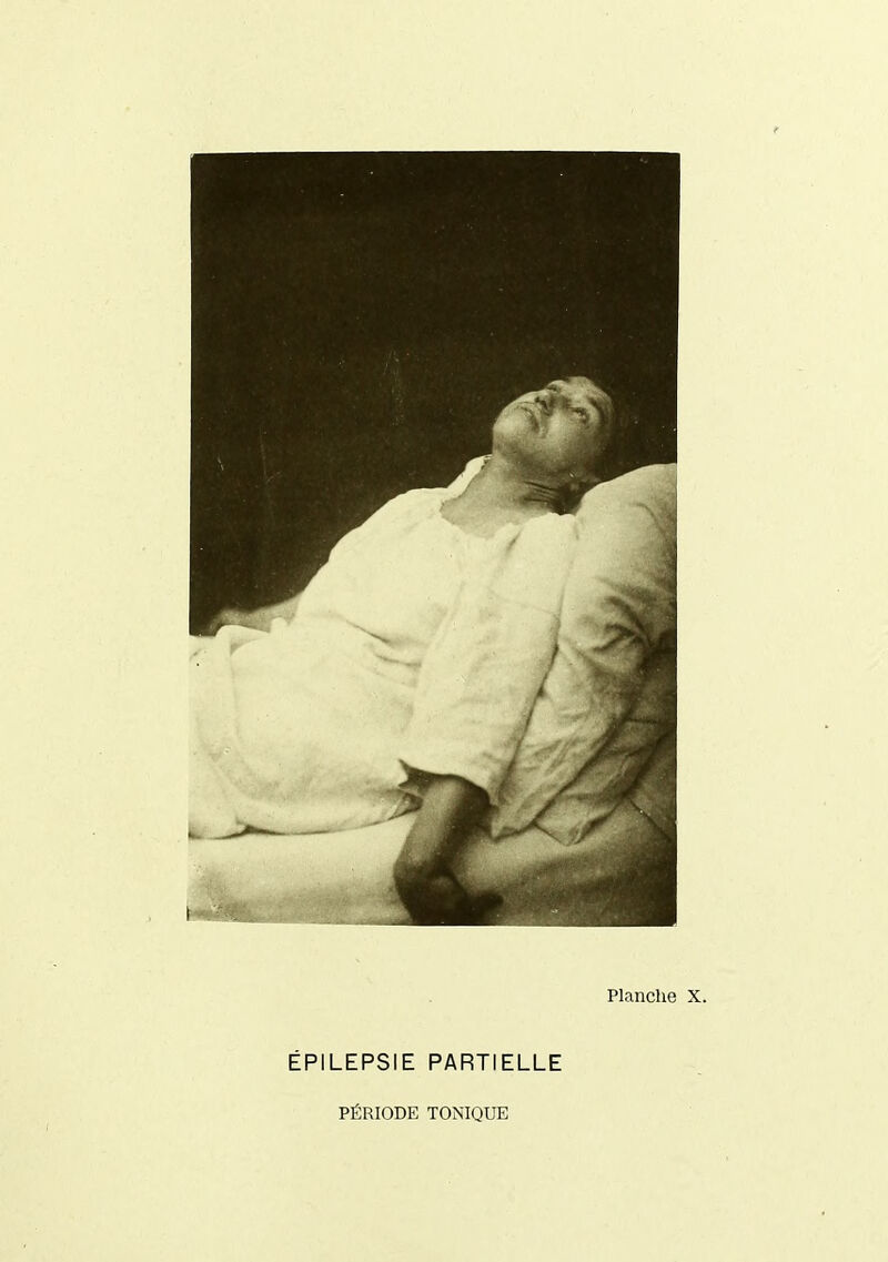 ÉPILEPSIE PARTIELLE