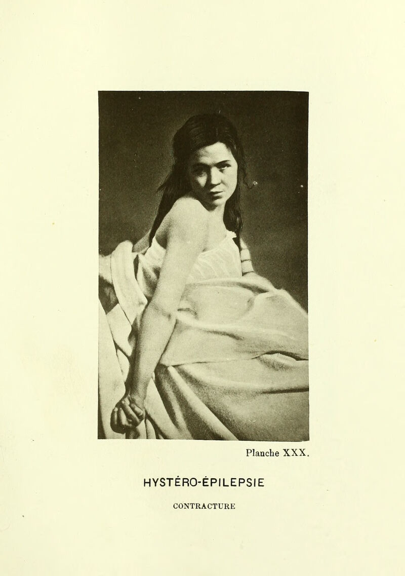 HYSTÉRO-ÉPILEPSIE CONTRACTURE