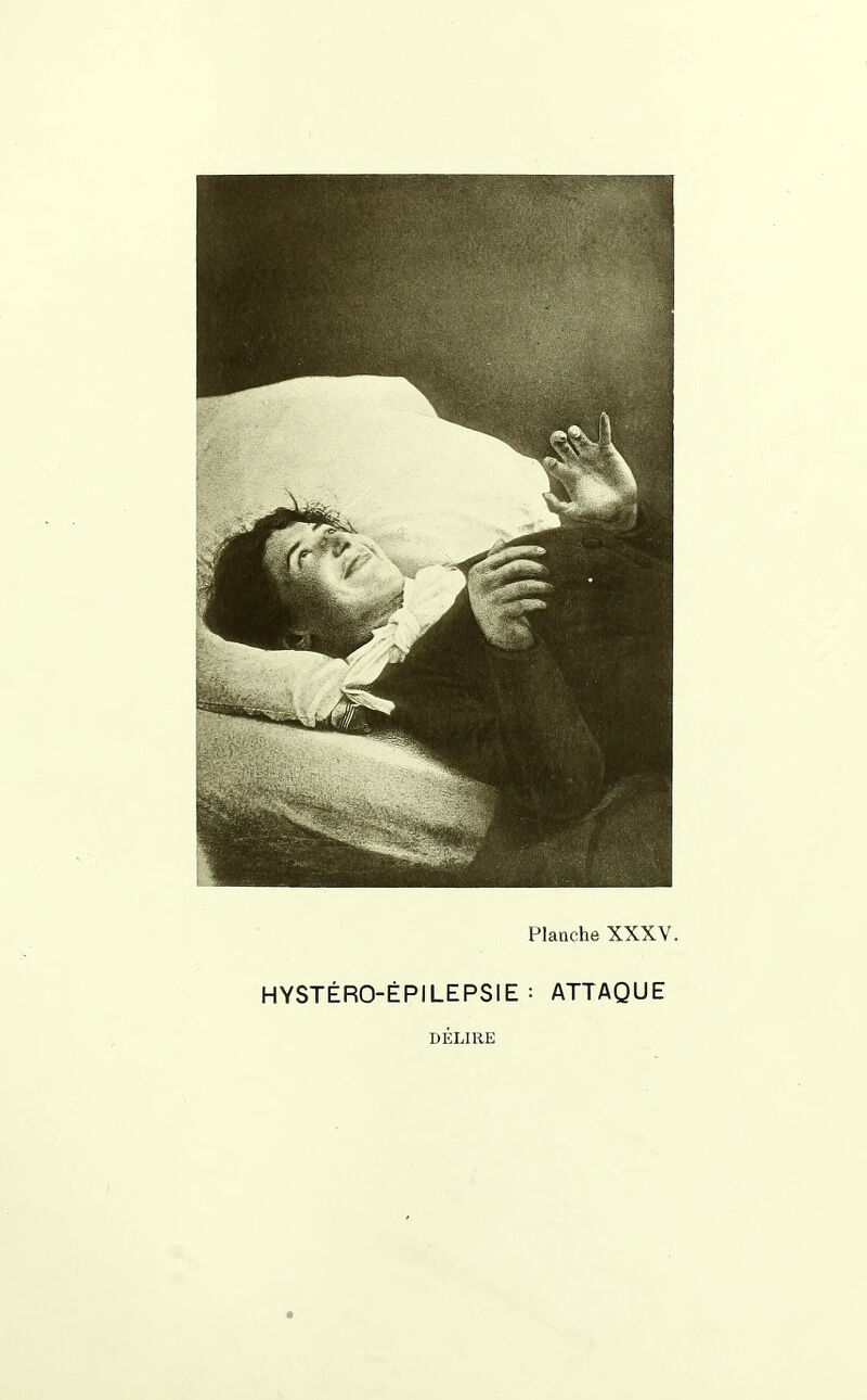 HYSTÉRO-ÉPILEPSIE : ATTAQUE DÉLIRE