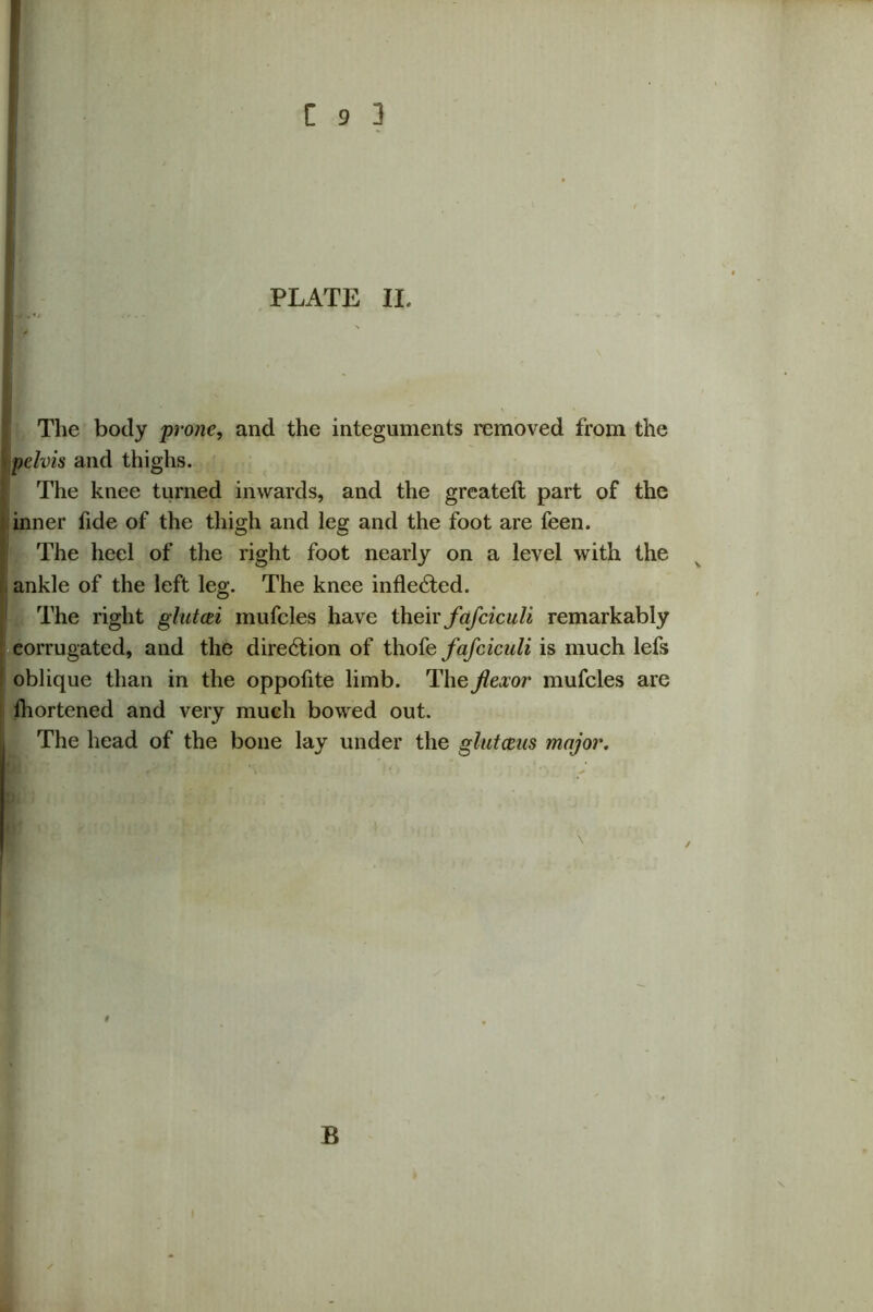The body prone, and the integuments removed from the pelvis and thighs. The knee turned inwards, and the greateft part of the inner fide of the thigh and leg and the foot are feen. The heel of the right foot nearly on a level with the ankle of the left leg. The knee inflected. The right glutcei mufcles have their fafciculi remarkably corrugated, and the direction of thofe fafciculi is much lefs oblique than in the oppofite limb. The flexor mufcles are fhortened and very much bowed out. The head of the bone lay under the glutceus major.