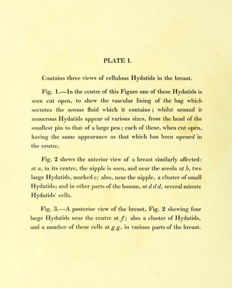 Contains three views of cellulous Hydatids in the breast. Fig. 1. —In the centre of this Figure one of these Hydatids is seen cut open, to shew the vascular lining of the bag which secretes the serous fluid which it contains ; whilst around it numerous Hydatids appear of various sizes, from the head of the smallest pin to that of a large pea ; each of these, when cut open, having the same appearance as that which has been opened’ in the centre. Fig. 2 shews the anterior view of a breast similarly affected: at «, in its centre, the nipple is seen, and near the areola at Z>, two large Hydatids, marked c; also, near the nipple, a cluster of small Hydatids; and in other parts of the bosom, ^ntddd, several minute Hydatids’ cells. Fig. 3.—A posterior view of the breast. Fig. 2 shewing four large Hydatids near the centre at f; also a cluster of Hydatids, and a number of these cells at^^, in various parts of the breast.