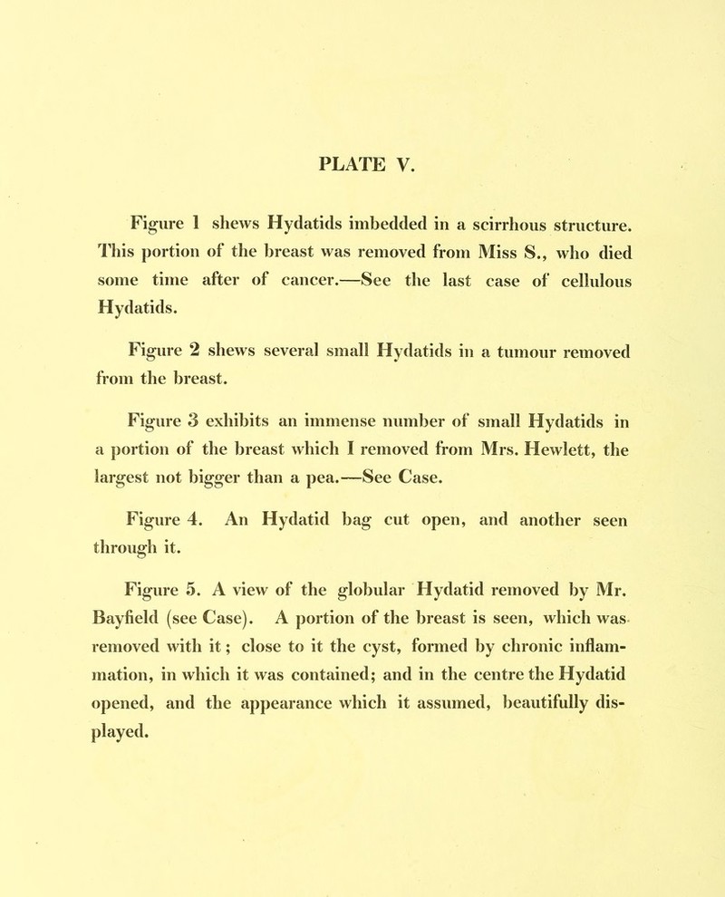 Figure 1 shews Hydatids imbedded in a scirrhous structure. This portion of the breast was removed from Miss S., who died some time after of cancer.—See the last case of cellulous Hydatids. Figure 2 shews several small Hydatids in a tumour removed from the breast. Figure 3 exhibits an immense number of small Hydatids in a portion of the breast which I removed from Mrs. Hewlett, the largest not bigger than a pea.—See Case. Figure 4. An Hydatid bag cut open, and another seen through it. Figure 5. A view of the globular Hydatid removed by Mr. Bayfield (see Case). A portion of the breast is seen, which was- removed with it; close to it the cyst, formed by chronic inflam- mation, in which it was contained; and in the centre the Hydatid opened, and the appearance which it assumed, beautifully dis- played.