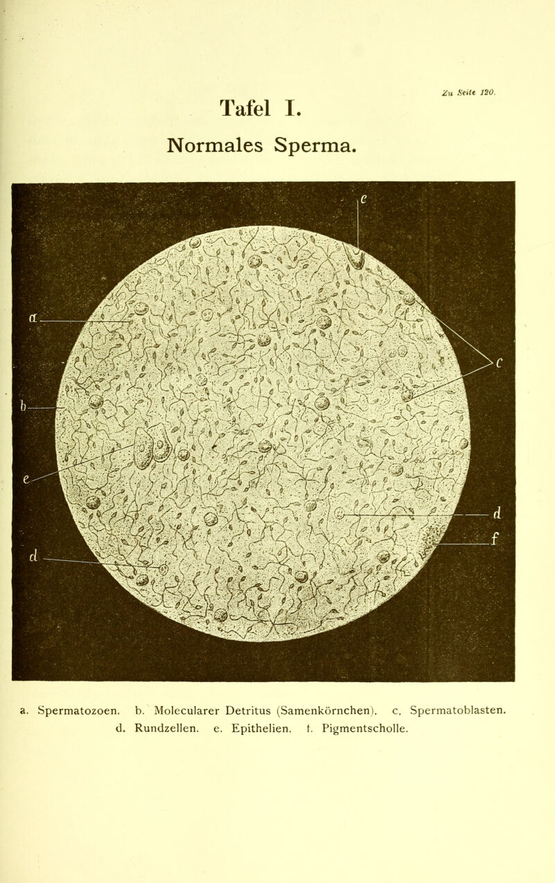 Normales Sperma Zu Seitt 120. Spermatozoen. b. Molecularer Detritus (Samenkörnchen), c. Spermatoblasten d. Rundzellen, e. Epithelien. 1. Pigmentscholle.