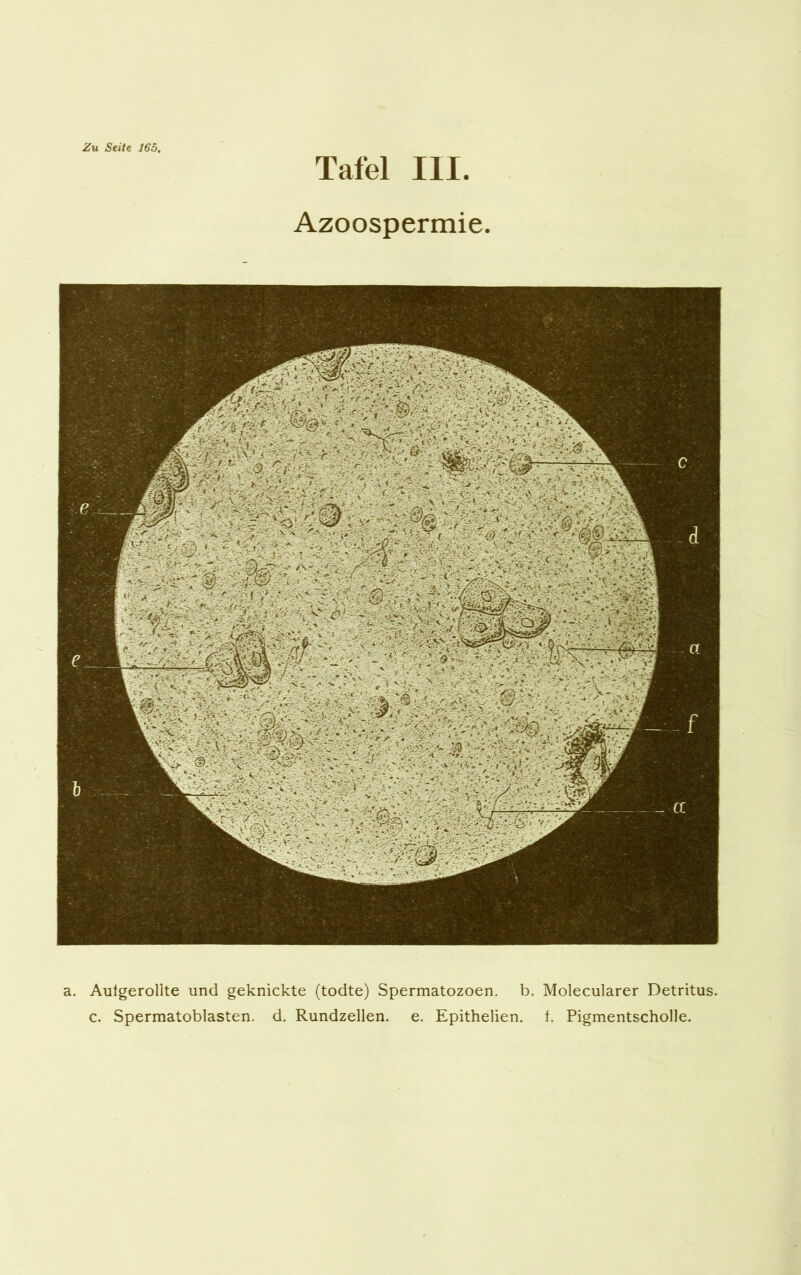 Zu Seite 165. Tafel III. Azoospermie Aufgerollte und geknickte (todte) Spermatozoen. b. Molecularer Detritus,