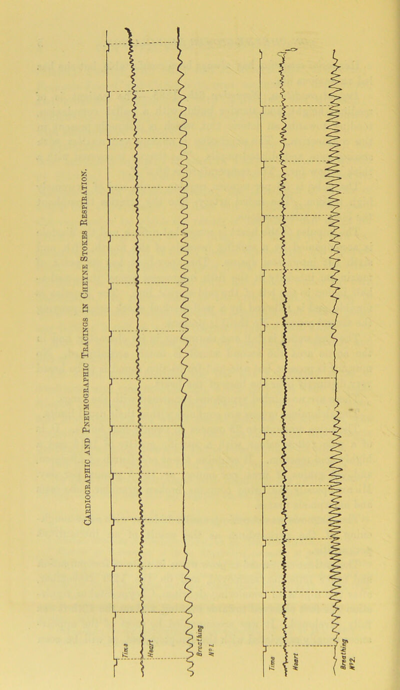 CAEDioGEAPnic AND Pneumogeaphic Teacings IN Cheyne Stokes Respieation. 1 Breathing H’>2.