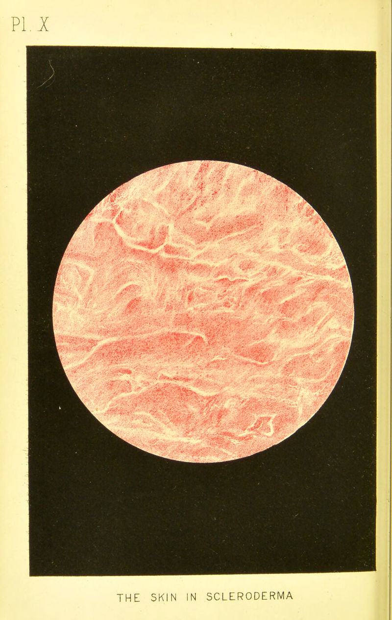 THE SKIN IN SCLERODERMA