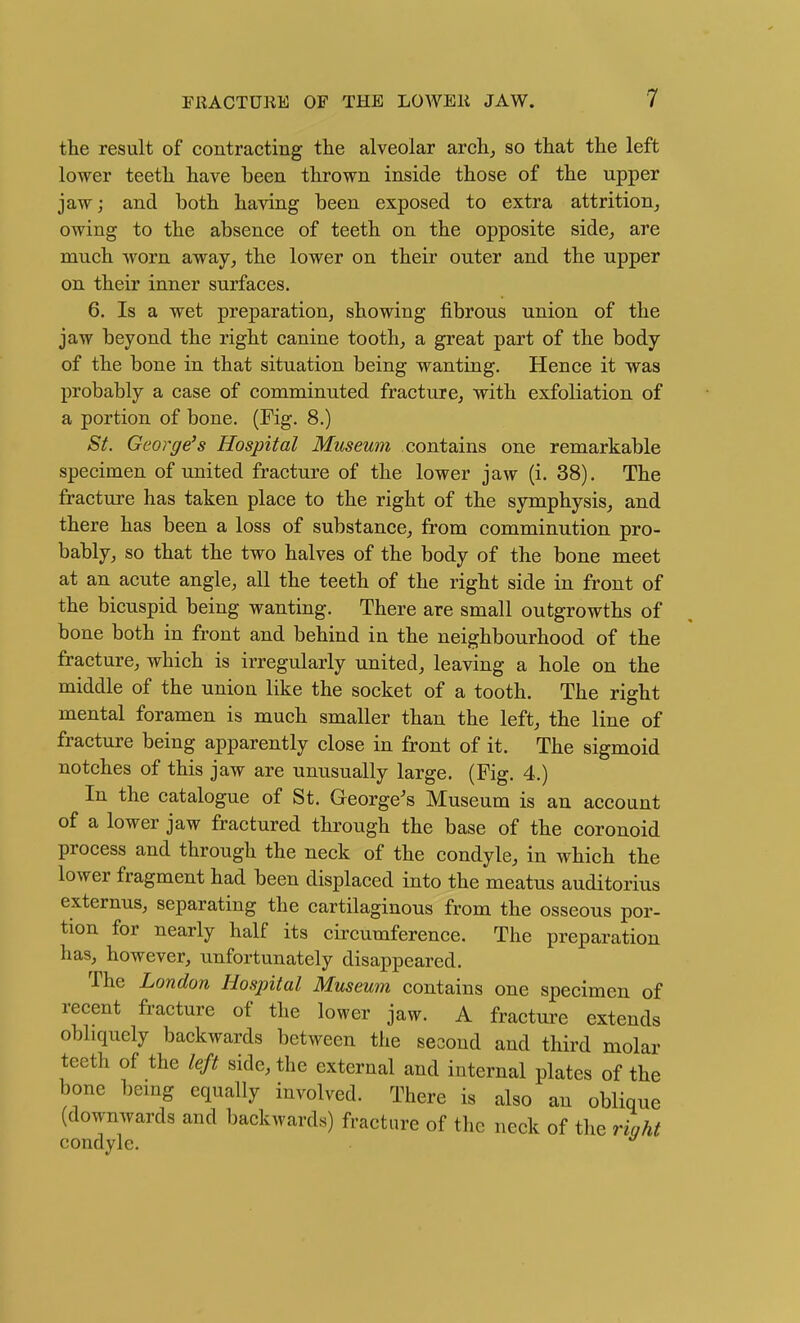 the result of contracting the alveolar arch^ so that the left lower teeth have been thrown inside those of the upper jaw; and both having been exposed to extra attrition^ owing to the absence of teeth on the opposite side^ are much worn away, the lower on their outer and the upper on their inner surfaces. 6. Is a wet preparation, showing fibrous union of the jaw beyond the right canine tooth, a great part of the body of the bone in that situation being wanting. Hence it was probably a case of comminuted fracture, with exfoliation of a portion of bone. (Fig. 8.) St. George's Hospital Museum contains one remarkable specimen of united fracture of the lower jaw (i. 38). The fracture has taken place to the right of the symphysis, and there has been a loss of substance, from comminution pro- bably, so that the two halves of the body of the bone meet at an acute angle, all the teeth of the right side in front of the bicuspid being wanting. There are small outgrowths of bone both in front and behind in the neighbourhood of the fracture, which is irregularly united, leaving a hole on the middle of the union like the socket of a tooth. The right mental foramen is much smaller than the left, the line of fracture being apparently close in front of it. The sigmoid notches of this jaw are unusually large. (Fig. 4.) In the catalogue of St. George's Museum is an account of a lower jaw fractured through the base of the coronoid process and through the neck of the condyle, in which the lower fragment had been displaced into the meatus auditorius externus, separating the cartilaginous from the osseous por- tion for nearly half its circumference. The preparation has, however, unfortunately disappeared. The London Hospital Museum contains one specimen of recent fracture of the lower jaw. A fractui'e extends obliquely backwards between the second and third molar teeth of the left side, the external and internal plates of the bone bemg equally involved. There is also an oblique (downwards and backwards) fracture of the neck of the right condyle.