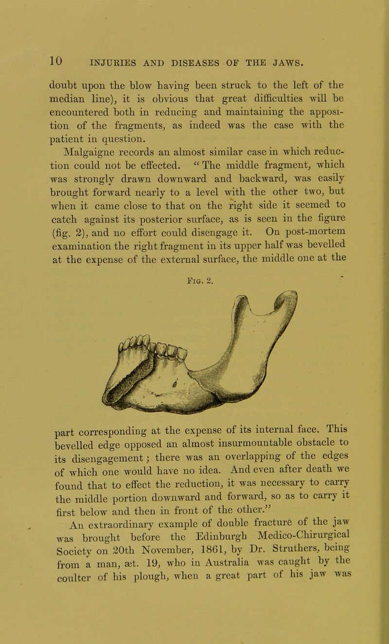 doubt upon the blow having been struck to the left of the median line), it is obvious that great difficulties will be encountered both in reducing and maintaining the apposi- tion of the fragments, as indeed was the case with the patient in question. Malgaigne records an almost similar case in which reduc- tion could not be effected.  The middle fragment, which was strongly drawn downward and backward, was easily brought forward nearly to a level with the other two, but when it came close to that on the right side it seemed to catch against its posterior surface, as is seen in the figure (fig. 2), and no effort could disengage it. On post-mortem examination the right fragment in its upper half was bevelled at the expense of the external surface, the middle one at the Fig. 2. part corresponding at the expense of its internal face. This bevelled edge opposed an almost insurmountable obstacle to its disengagement; there was an overlapping of the edges of which one would have no idea. And even after death we found that to effect the reduction, it was necessary to carry the middle portion downward and forward, so as to carry it first below and then in front of the other. An extraordinary example of double fractm-e of the jaw was brought before the Edinbui'gh Medico-Chii-urgical Society on 20th November, 1861, by Dr. Struthers, being from a man, a;t. 19, who in Australia was caught by the coulter of his plough, when a great part of his jaw was