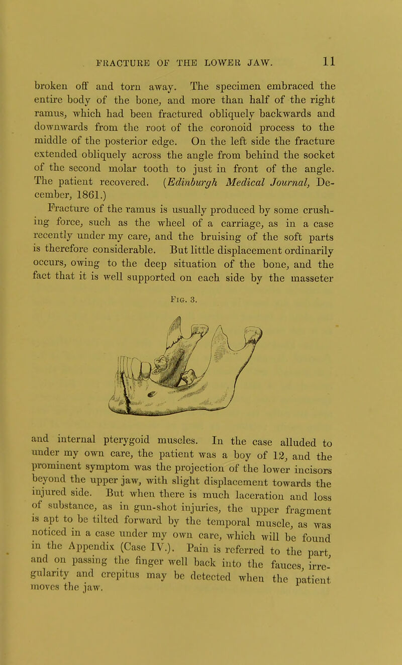 broken off and torn away. The specimen embraced the entire body of the bone^ and more than half of the right ramus, which had been fractured obliquely backwards and downwards from the root of the coronoid process to the middle of the posterior edge. On the left side the fracture extended obliquely across the angle from behind the socket of the second molar tooth to just in front of the angle. The patient recovered. {Edinburgh Medical Journal, De- cember, 1861.) Fracture of the ramus is usually produced by some crush- ing force, such as the wheel of a carriage, as in a case recently under my care, and the bruising of the soft parts is therefore considerable. But little displacement ordinarily occurs, owing to the deep situation of the bone, and the fact that it is well supported on each side by the masseter Fig. 3. and internal pterygoid muscles. In the case alluded to under my own care, the patient was a boy of 12, and the prominent symptom was the projection of the lower incisors beyond the upper jaw, with slight displacement towards the mjured side. But when there is much laceration and loss of substance, as in gun-shot injui-ies, the upper fragment is apt to be tilted forward by the temporal muscle, as was noticed in a case under my own care, which will be found in the Appendix (Case IV.). Pain is referred to the part and on passing the finger well back into the fauces irre' gularity and crepitus may be detected when the p'atient moves the jaw.